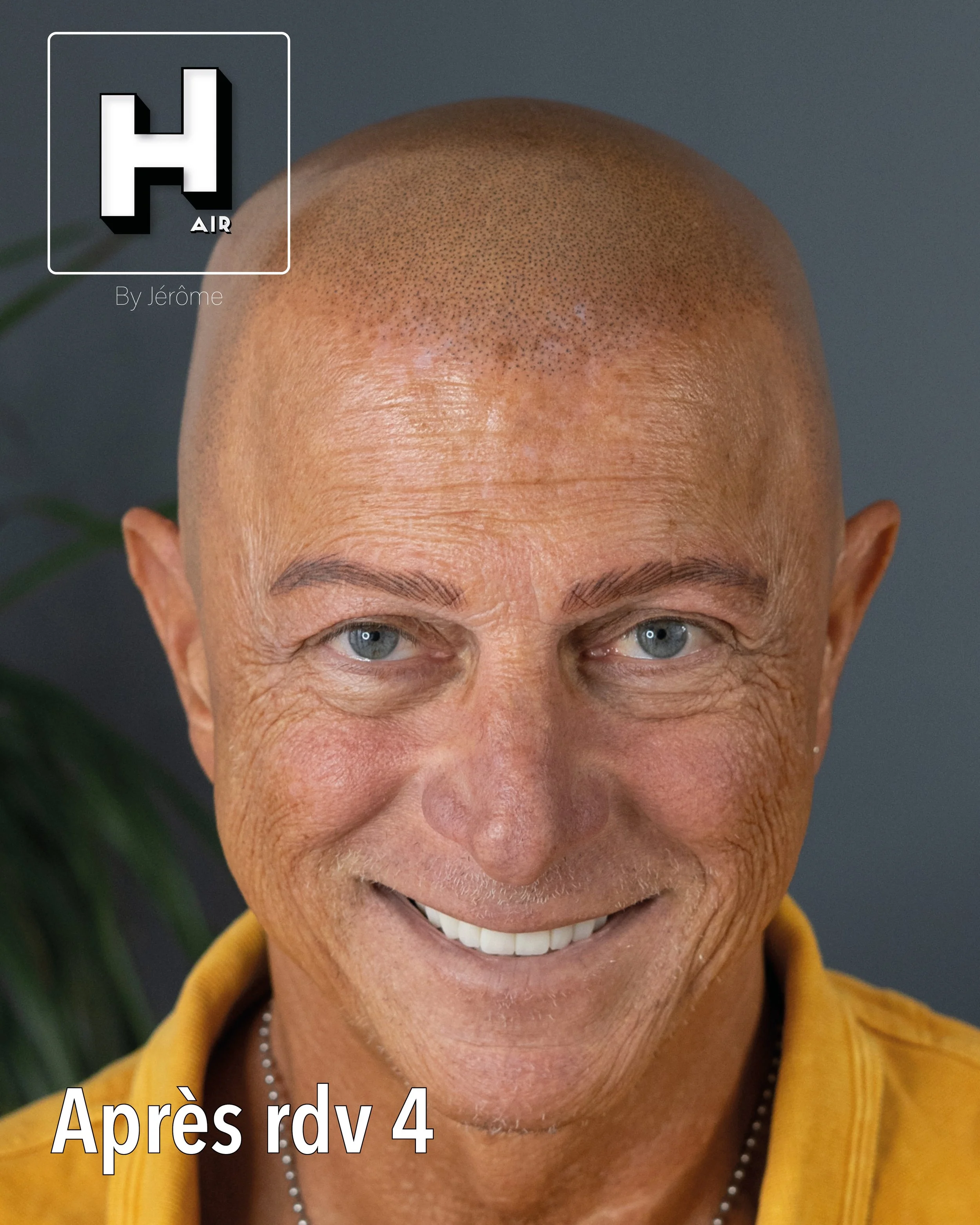 Une réponse possible face à l’alopécie universelle