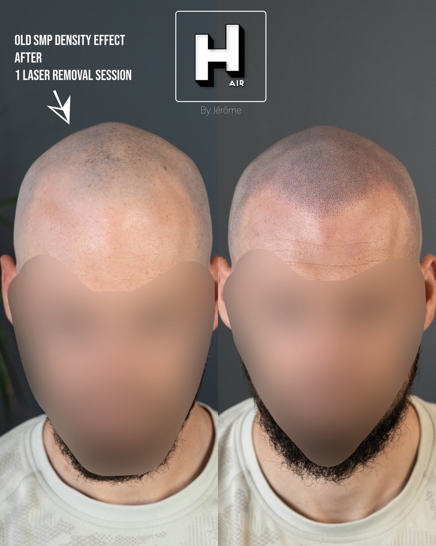 The old to the new 🔥

Changer une ancienne Smp effet densit&eacute; en effet ras&eacute;, apr&egrave;s 1 s&eacute;ance de laser ⚡️

R&eacute;serve ta consultation gratuite d&egrave;s maintenant 👇🏻 👉🏻 www.hairbyjerome.be 👉🏻 0477 524108 👉🏻hair