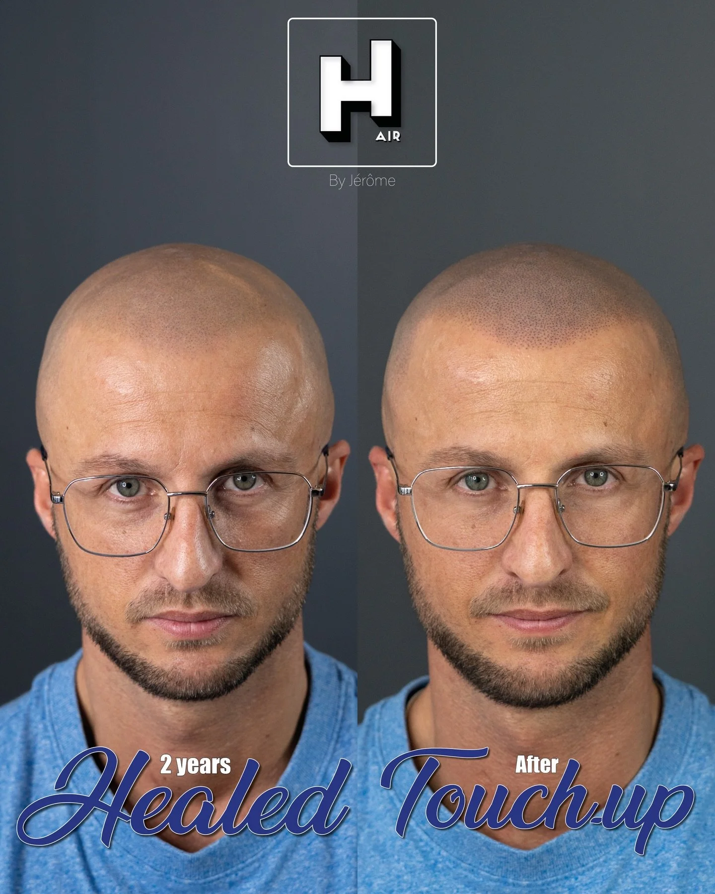 Time flies !
Vous vous demandez peut-&ecirc;tre a quoi ressemble une SMP cicatris&eacute;e ? Voici le r&eacute;sultat d&rsquo;une SMP, apr&egrave;s deux ans de cicatrisation, avant et apr&egrave;s la retouche.
Toujours dans un soucis de d&eacute;tail