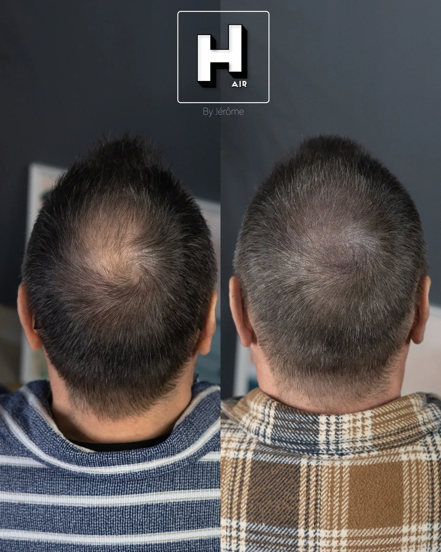 No worry, just add density 🙌🏻
Camouflage naturel et discret du vertex 😍

R&eacute;serve ta consultation gratuite d&egrave;s maintenant 👇🏻 👉🏻 www.hairbyjerome.be 👉🏻 0477 524108 👉🏻hairbyjerome.namur@gmail.com . &laquo;&nbsp;99 problems but m