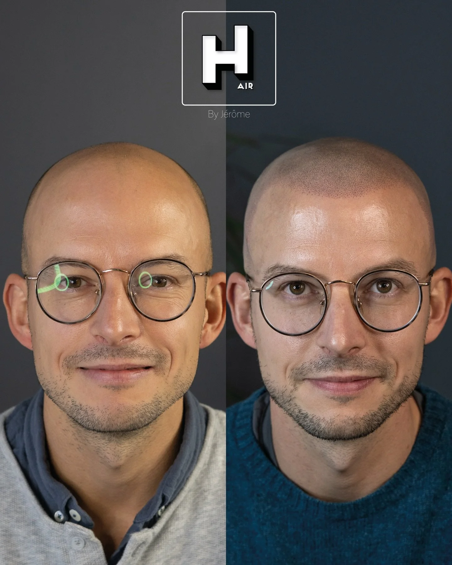 Toute l&rsquo;important d&rsquo;une ligne frontale, combin&eacute; &agrave; la finesse et &agrave; la pr&eacute;cision d&rsquo;une SMP contr&ocirc;l&eacute;e 😍
R&eacute;serve ta consultation gratuite d&egrave;s maintenant 👇🏻
👉🏻 www.hairbyjerome.