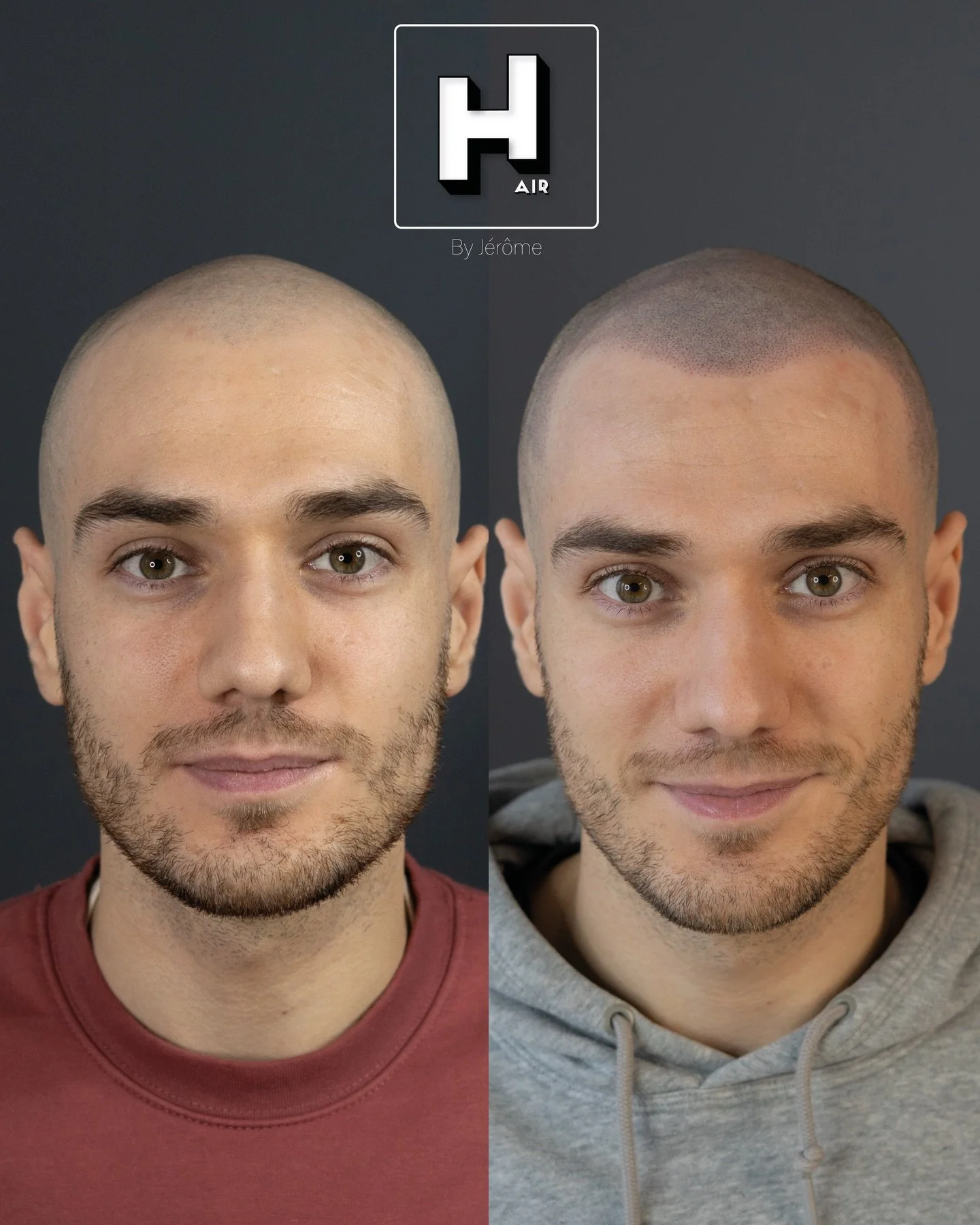 L&rsquo;effet ras&eacute;, la solution id&eacute;ale pour un effet naturel, sans passer par la chirurgie 👨🏻&zwj;⚕️, sans attendre 1 an pour esp&eacute;rer voir le r&eacute;sultat final ⌛️
R&eacute;serve ta consultation gratuite d&egrave;s maintenan