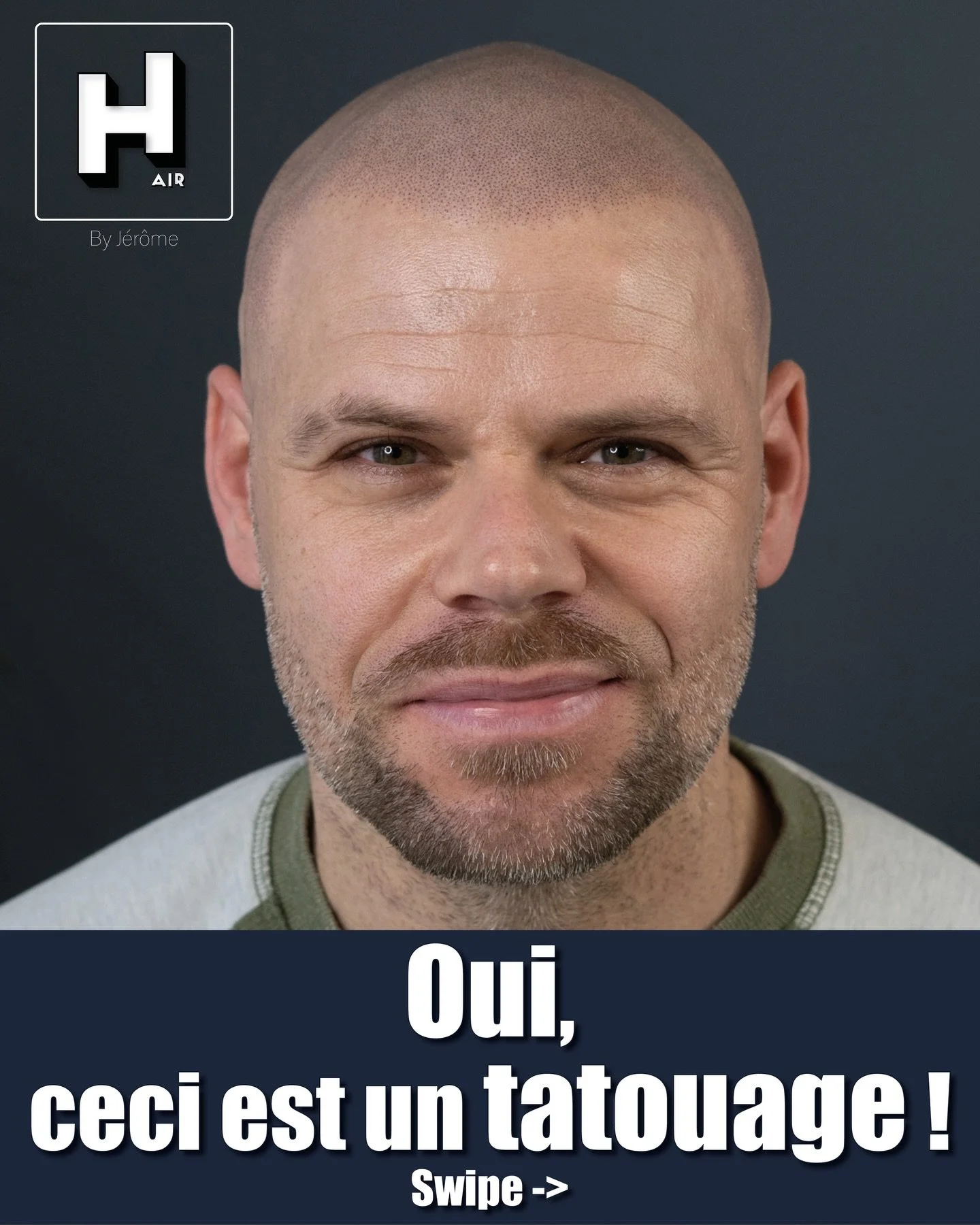 Oui, ceci est bien un tatouage !
Quand on parle de micropigmentation du cuir chevelu (SMP), il est essentiel de clarifier un point : oui, ceci est bien un tatouage. Le r&eacute;sultat que vous voyez sur la photo est obtenu gr&acirc;ce &agrave; une te