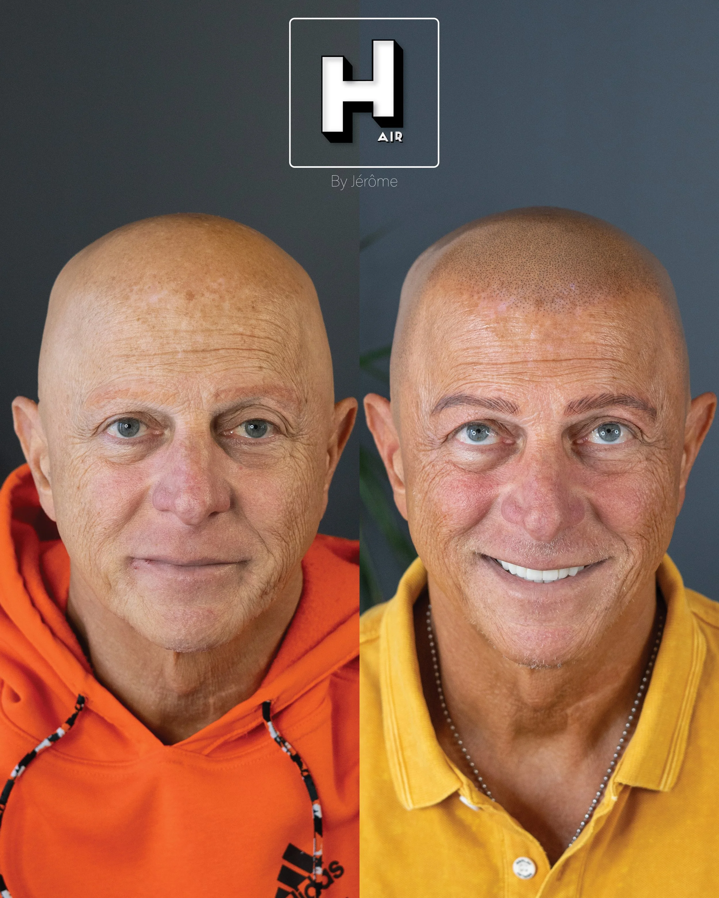 alopecie  universelle hair by jerome smp.jpg