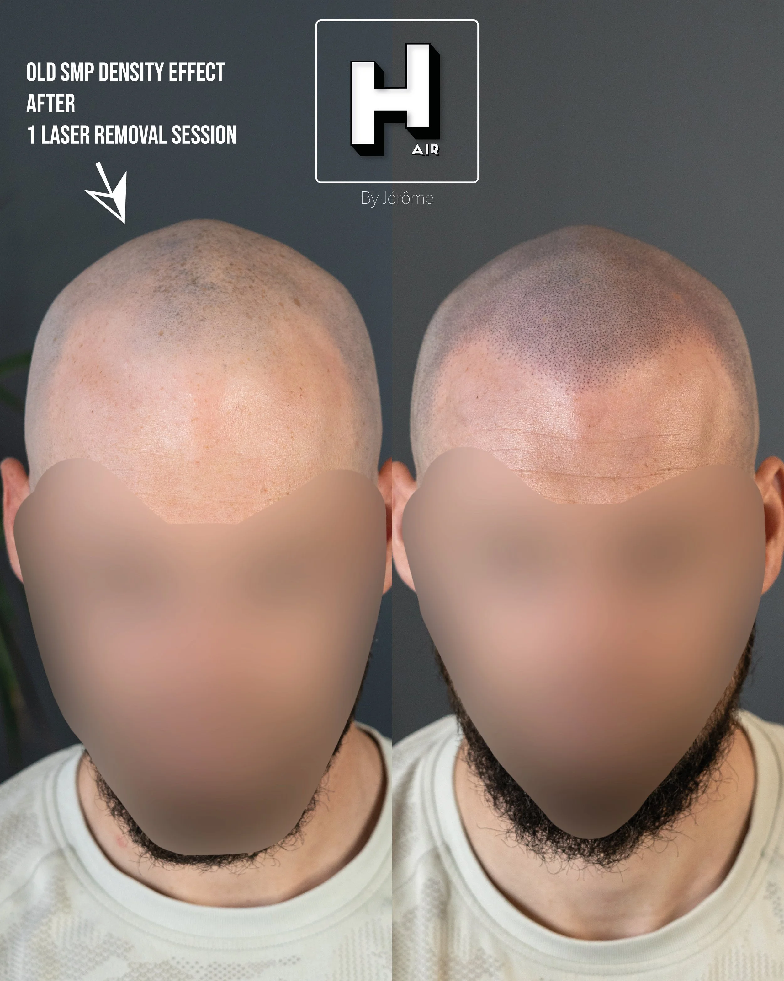effet rasé hair by jerome smp belgique apres laser2.jpg