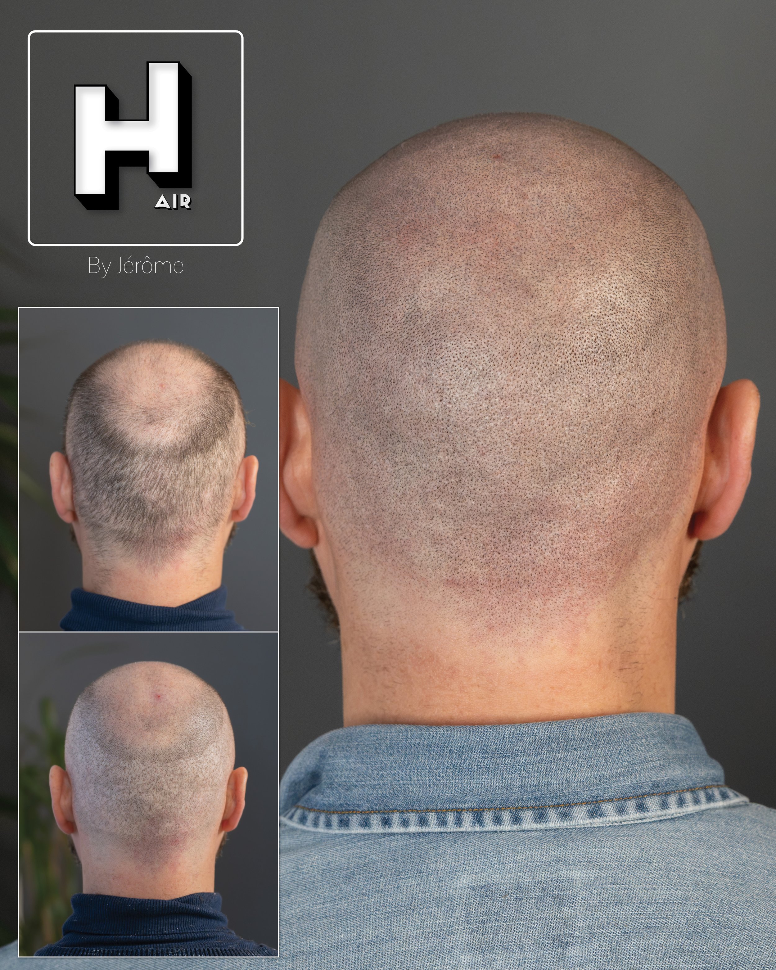 smp  effet rasé greffe cheveux turquie fue smpartistbelgium hairbyjerome17.jpg