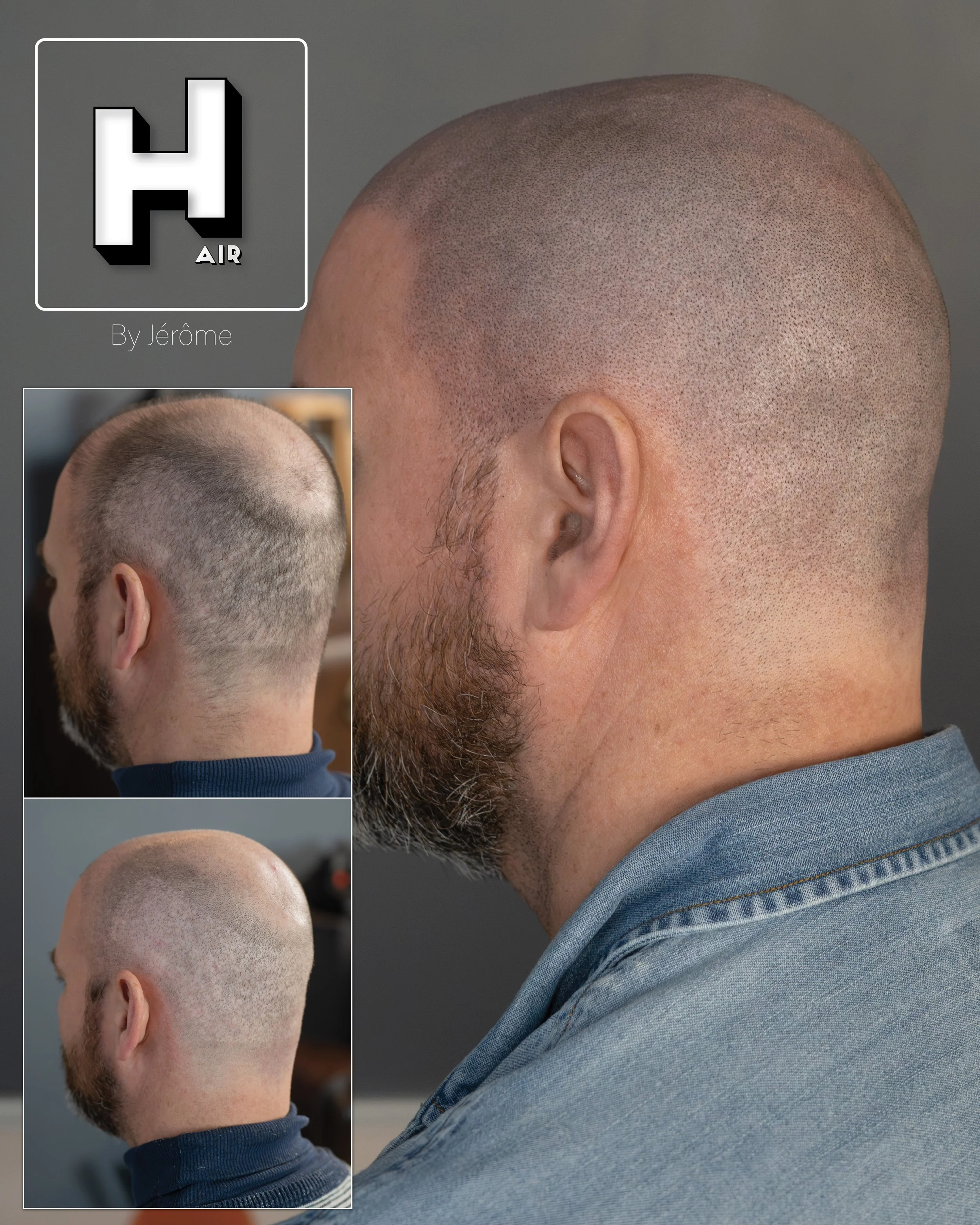 smp  effet rasé greffe cheveux turquie fue smpartistbelgium hairbyjerome25.jpg