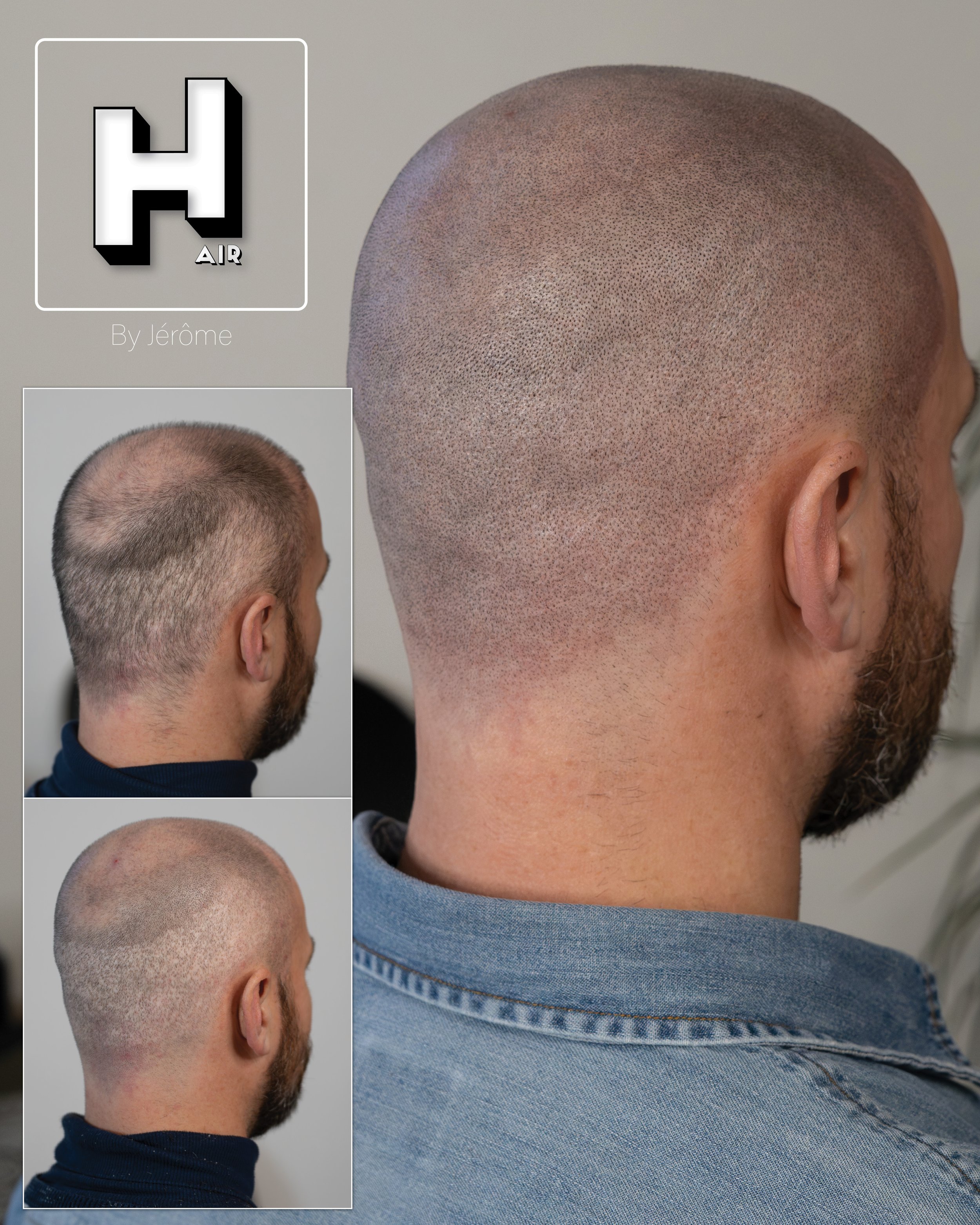 smp  effet rasé greffe cheveux turquie fue smpartistbelgium hairbyjerome21.jpg