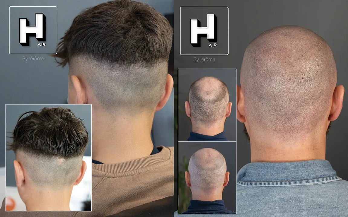 Camouflage de cicatrices en micropigmentation capillaire (SMP)