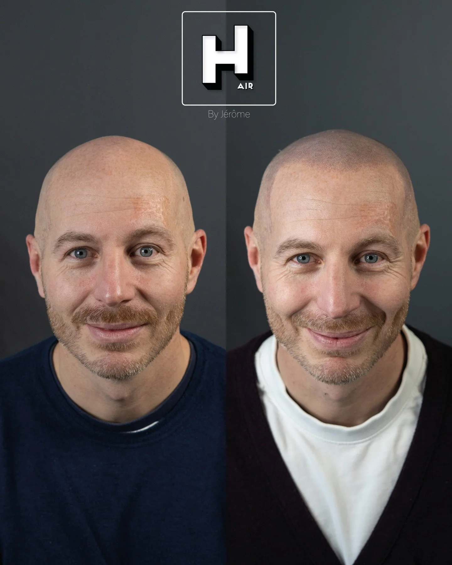 Changement perceptible 😍, technique invisible 🥷
l&rsquo;effet ras&eacute; en SMP vous permet de retrouver une ligne frontale, des expressions et des proportions dans le visage qui avaient disparues , sans passer par la case chirurgie 👨🏻&zwj;⚕️
R&