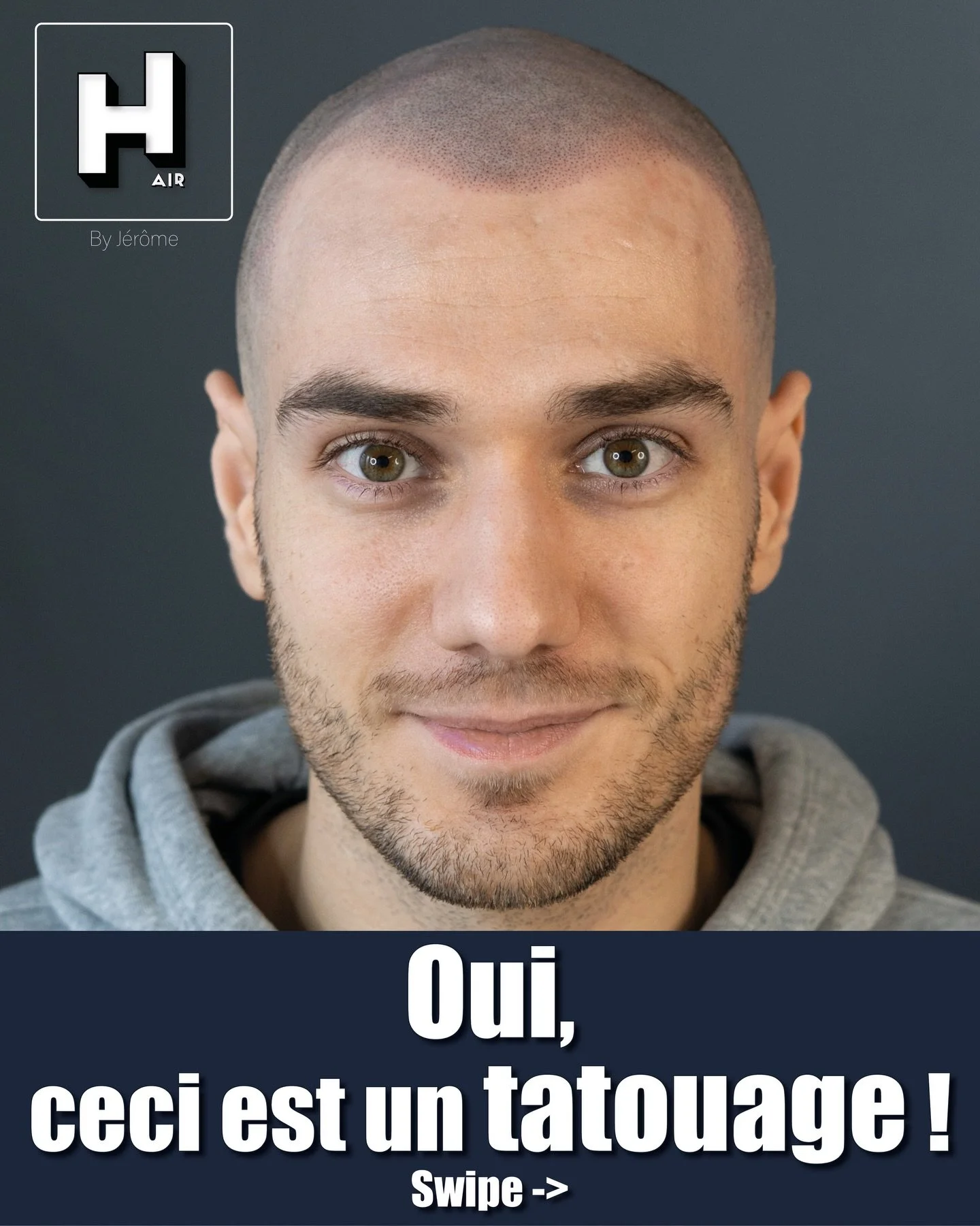 Oui, ceci est bien un tatouage !
Quand on parle de micropigmentation du cuir chevelu (SMP), il est essentiel de clarifier un point : oui, ceci est bien un tatouage. Le r&eacute;sultat que vous voyez sur la photo est obtenu gr&acirc;ce &agrave; une te