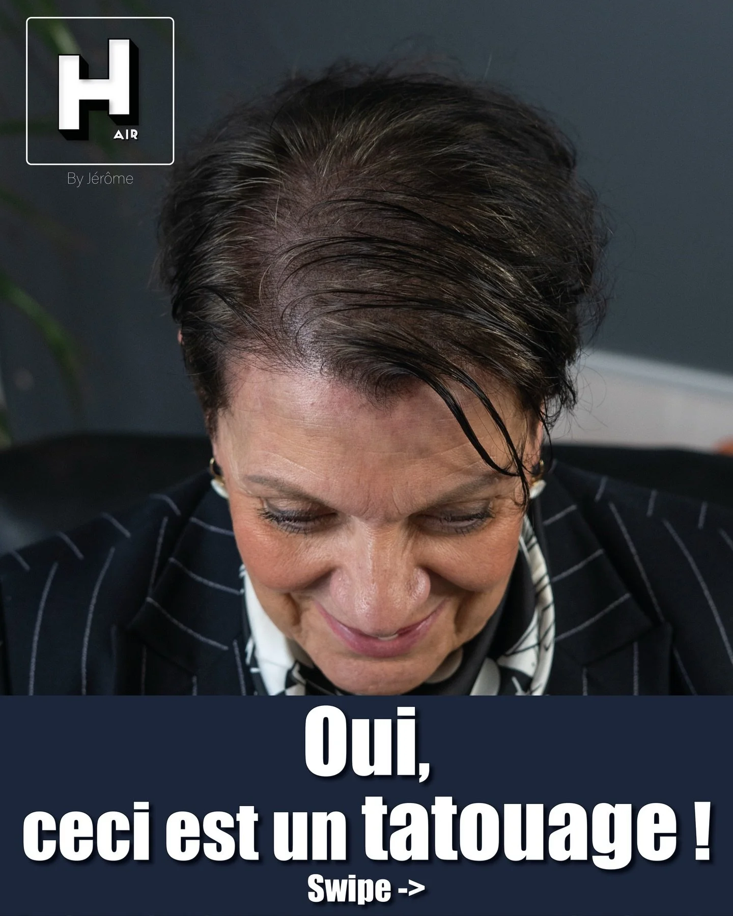 Oui, ceci est bien un tatouage !
Quand on parle de micropigmentation du cuir chevelu (SMP), il est essentiel de clarifier un point : oui, ceci est bien un tatouage. Le r&eacute;sultat que vous voyez sur la photo est obtenu gr&acirc;ce &agrave; une te