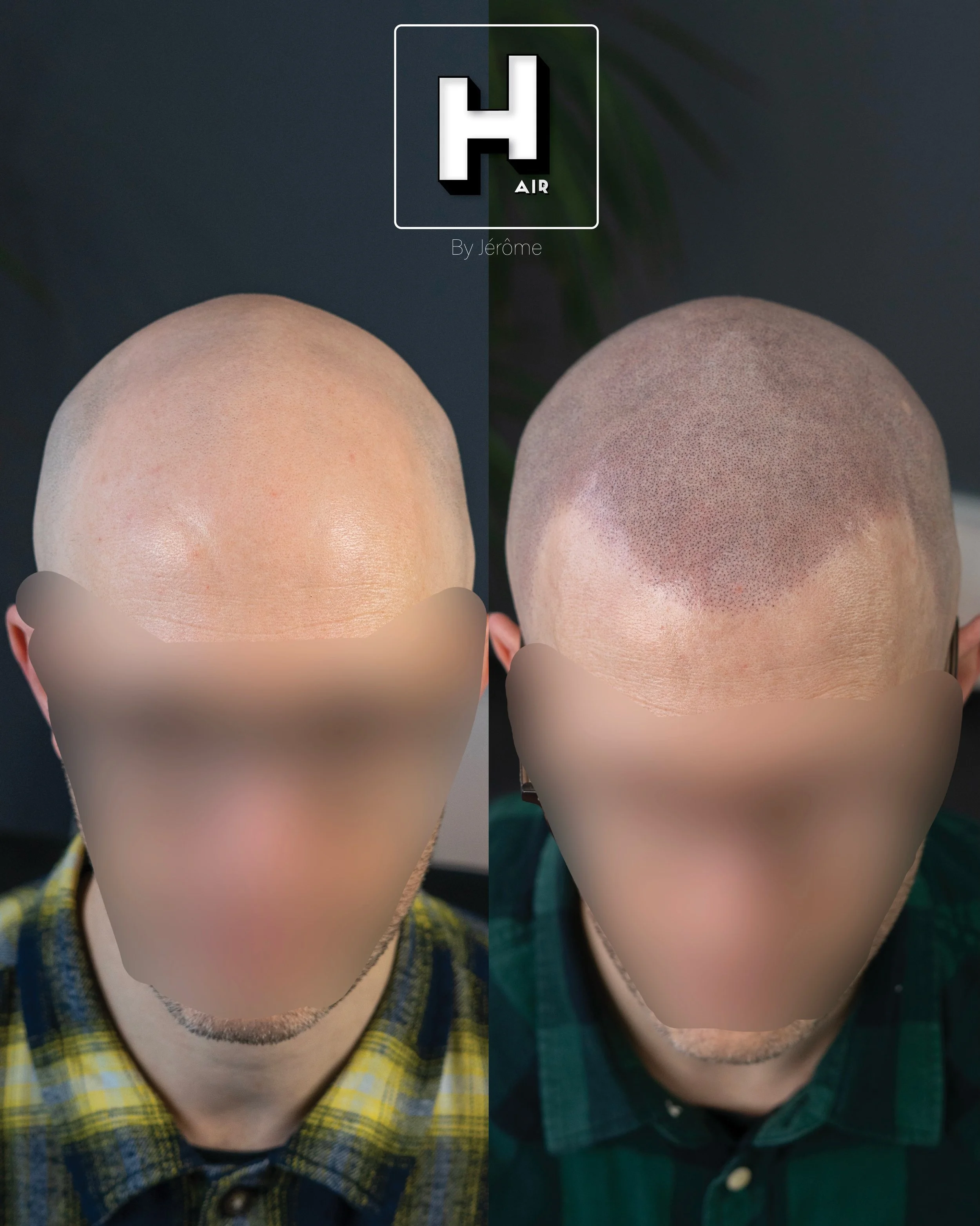 Donner un r&eacute;sultat naturel, cr&eacute;er une perfection imparfaite, comme toujours 🙌🏻
Tips client 🧯: les rougeurs sont normales et disparaissent assez rapidement dans les heures qui suivent.
Tips pro 🎁 : shooter en raw avec avec un apparei