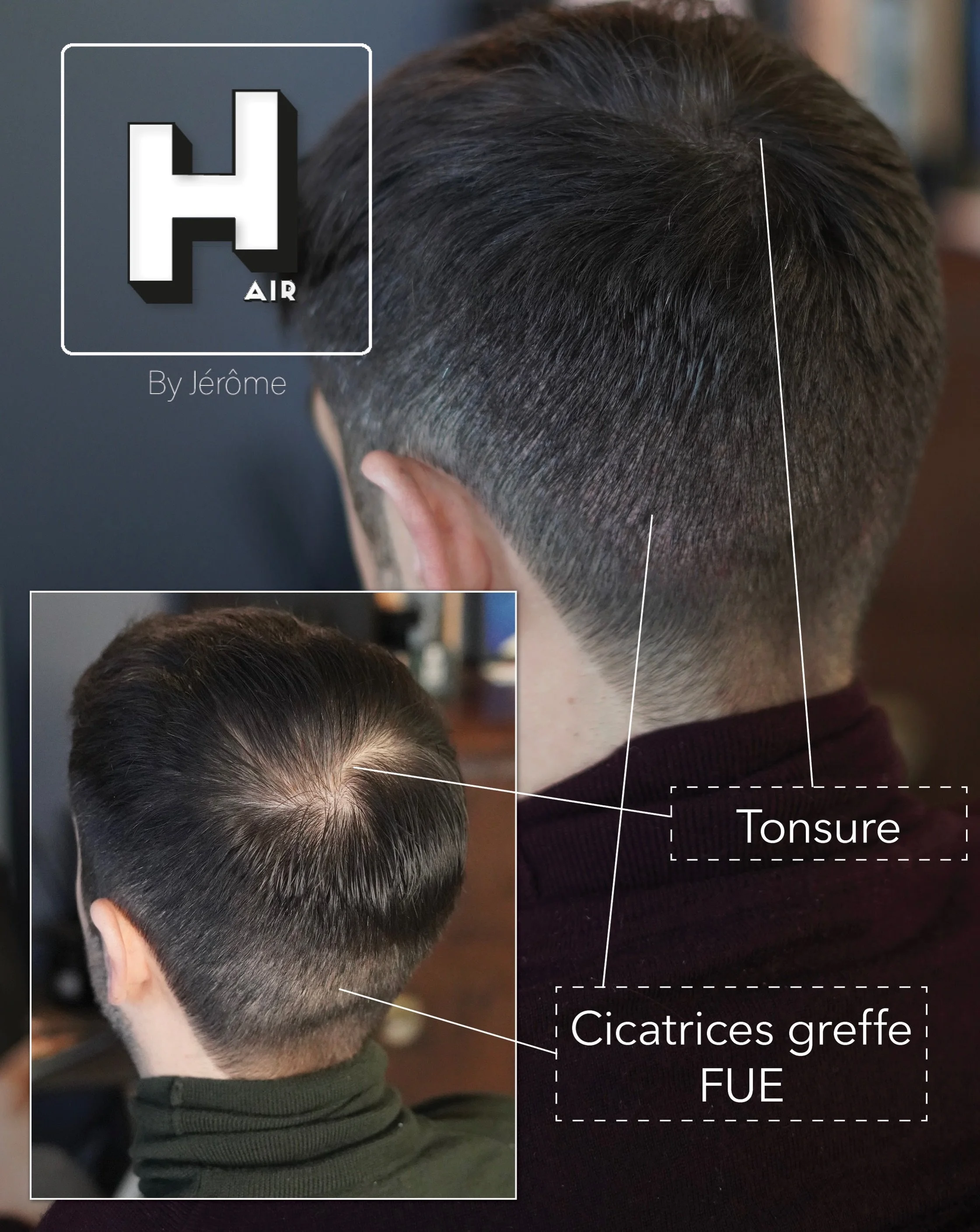 3 greffes de cheveux sur le vertex, 2 en Belgique 🇧🇪, 1 en Turquie 🇹🇷
Le seul &laquo;&nbsp;plus&nbsp;&raquo; de la greffe turc ? Les cicatrices visibles (et le douleur).
La solution : SMP du vertex et en camouflage des cicatrices 💪🏻
R&eacute;se