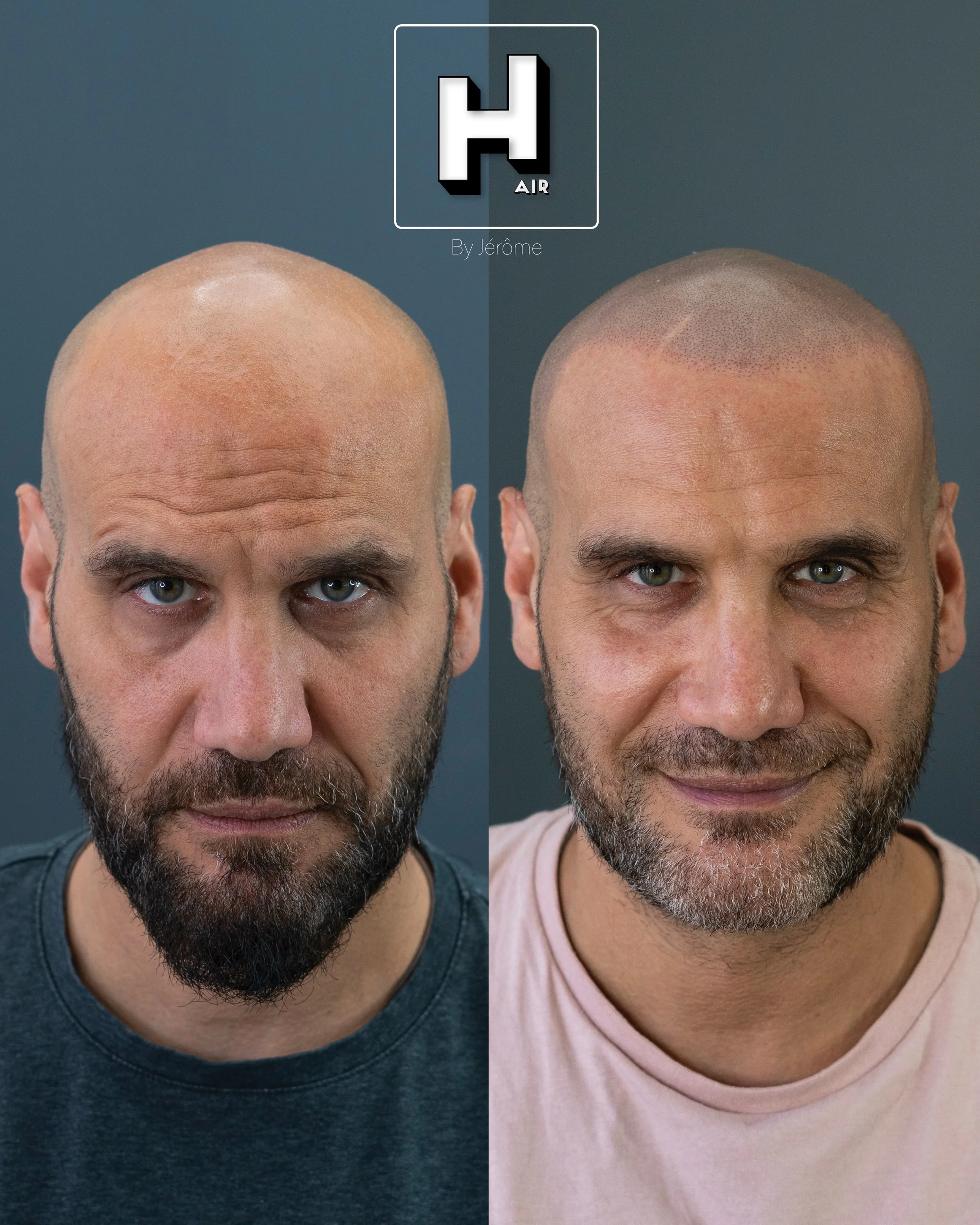 Back to the basics 💪🏻
Effet ras&eacute; naturel, int&eacute;gration de la cicatrice pour un effet hyper r&eacute;aliste 🤝
Zoom 🔎 sur les d&eacute;tails, chaque points de la ligne frontale est minutieusement plac&eacute;, on prend le temps de cons