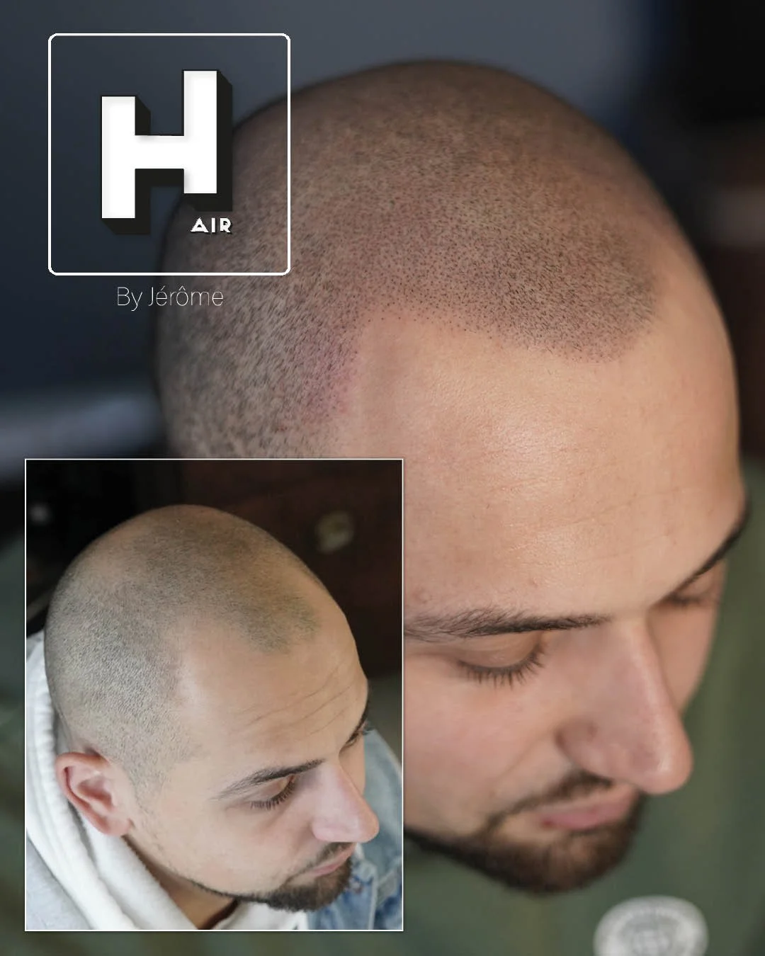 Micropigmentation Capillaire pour perte de cheveux chez l'homme