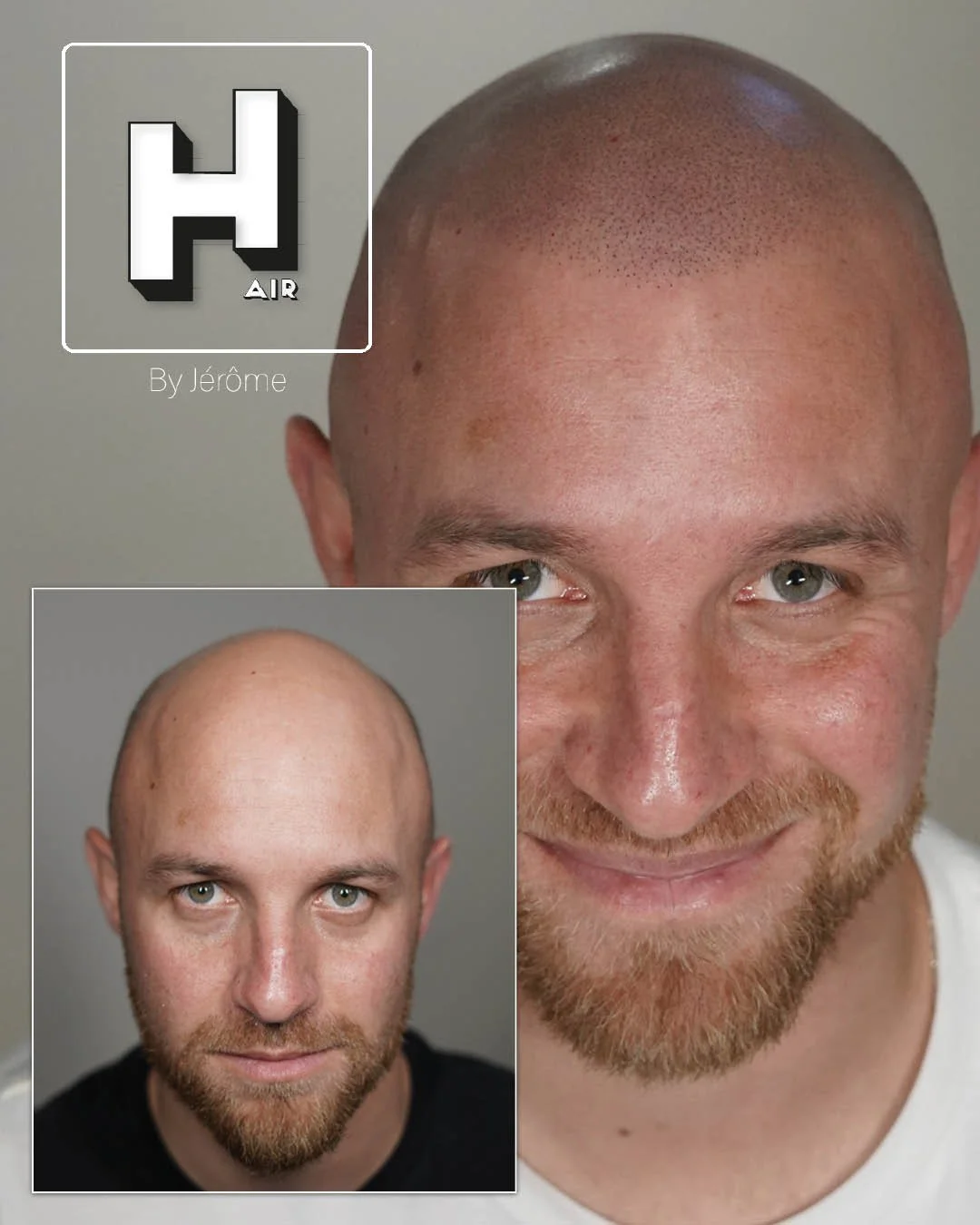 Micropigmentation Capillaire pour perte de cheveux chez l'homme