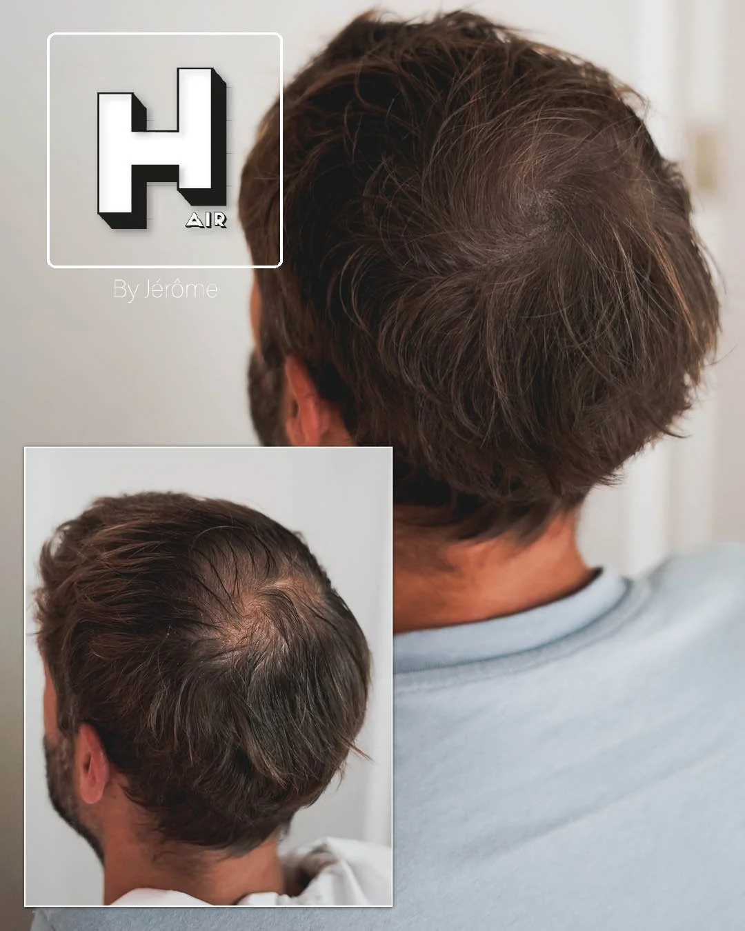Micropigmentation Capillaire pour perte de cheveux chez l'homme