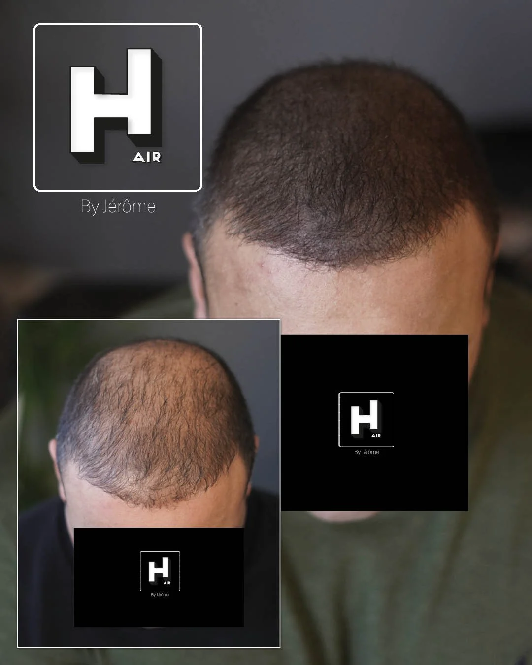 Micropigmentation Capillaire pour perte de cheveux chez l'homme