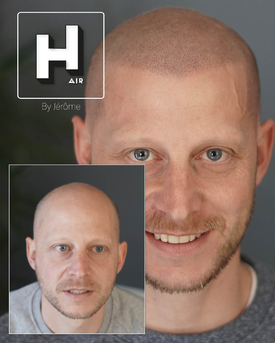 Micropigmentation Capillaire pour perte de cheveux chez l'homme