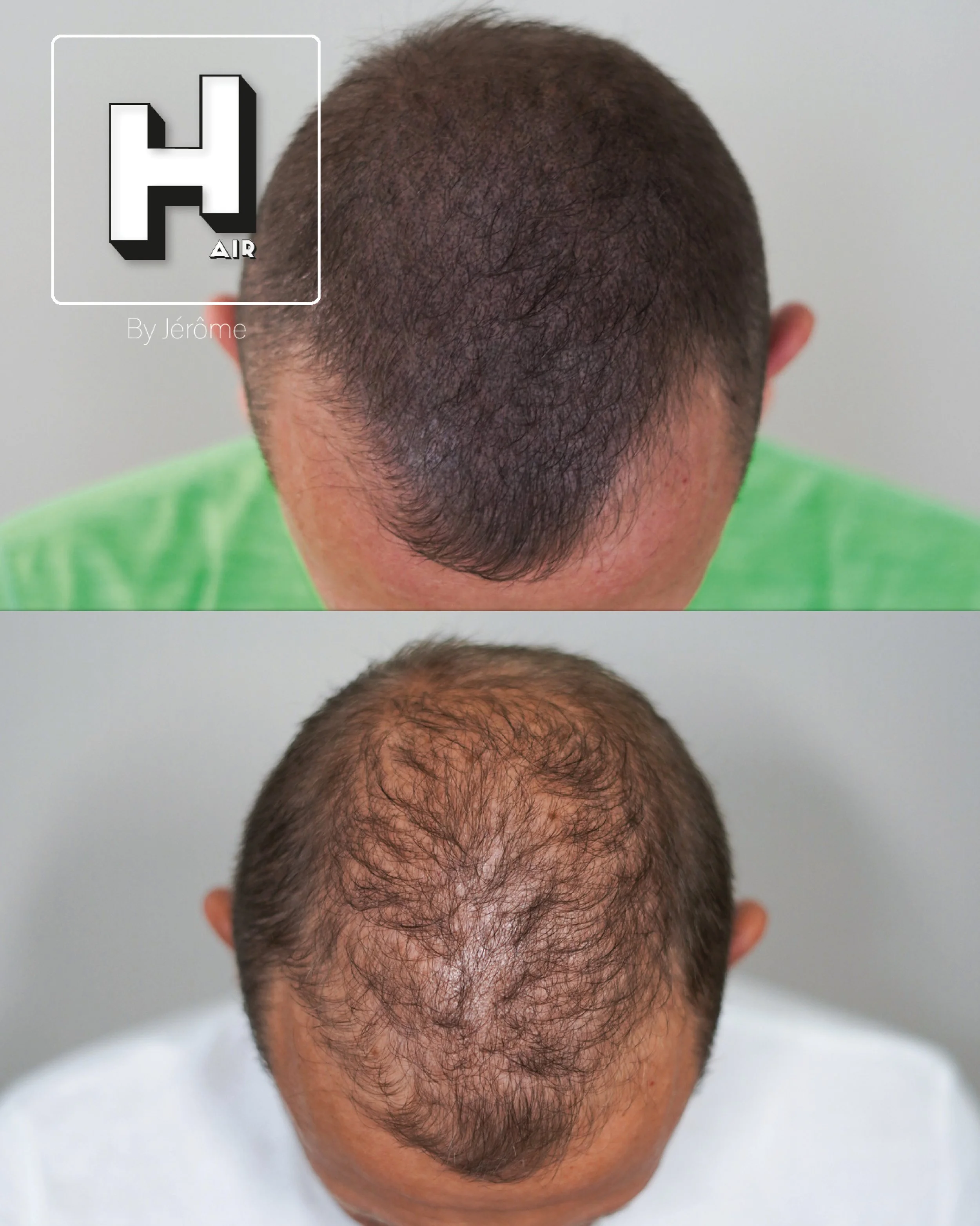 Micropigmentation Capillaire pour perte de cheveux chez l'homme
