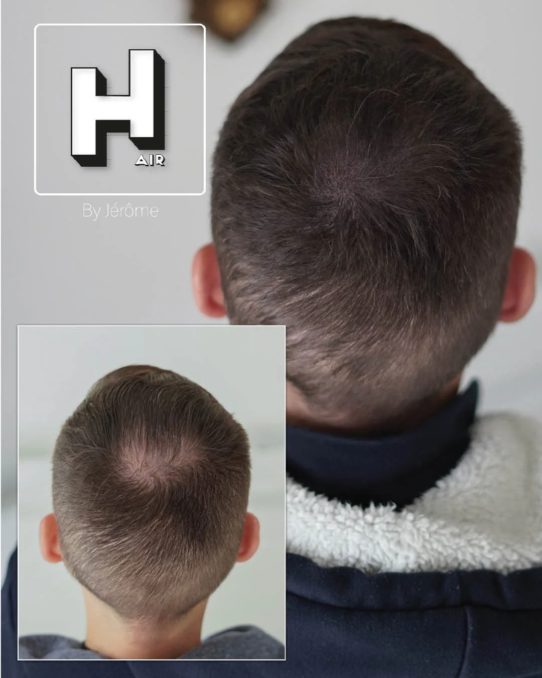 Micropigmentation Capillaire pour perte de cheveux chez l'homme