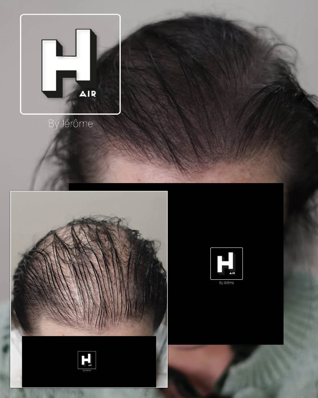 Micropigmentation Capillaire pour perte de cheveux chez la femme