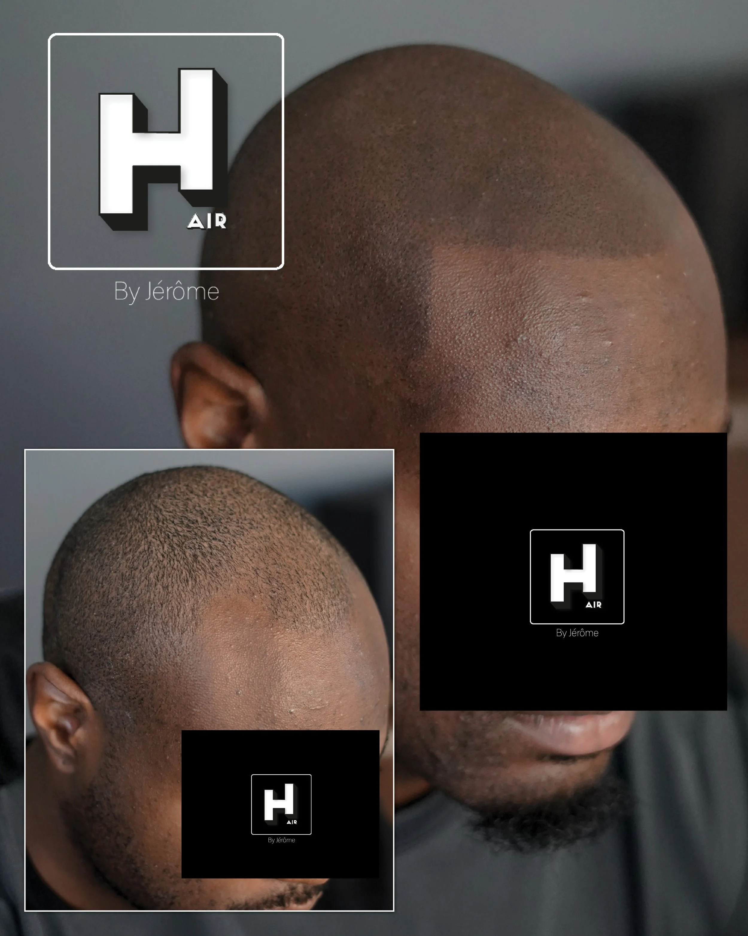 Micropigmentation Capillaire pour perte de cheveux chez l'homme