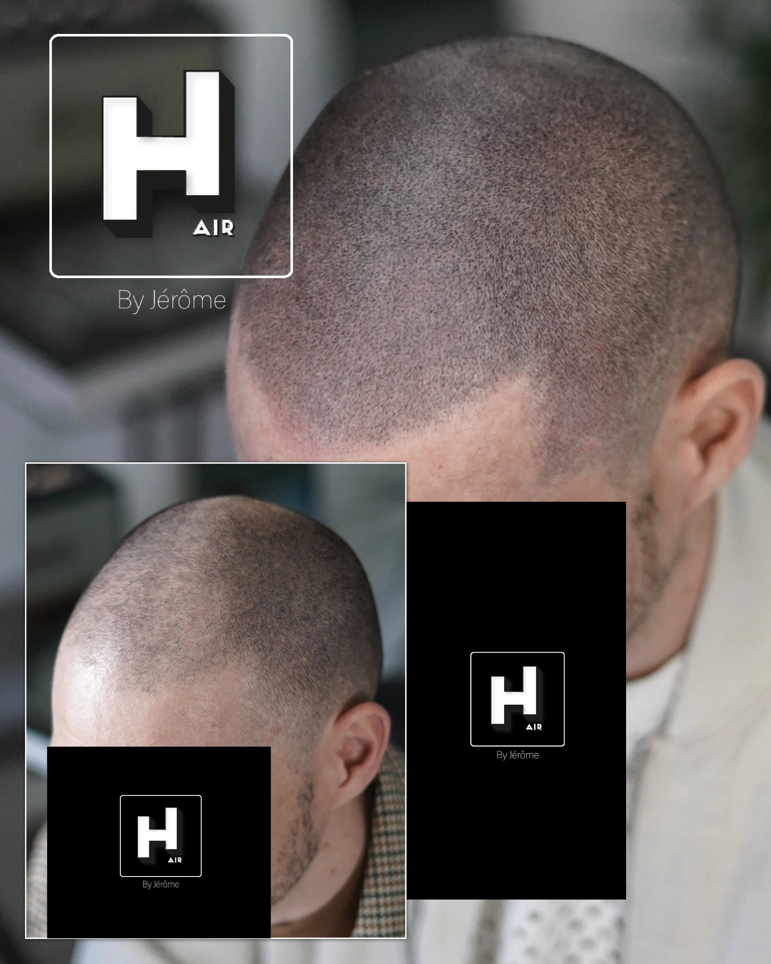 Micropigmentation Capillaire pour perte de cheveux chez l'homme