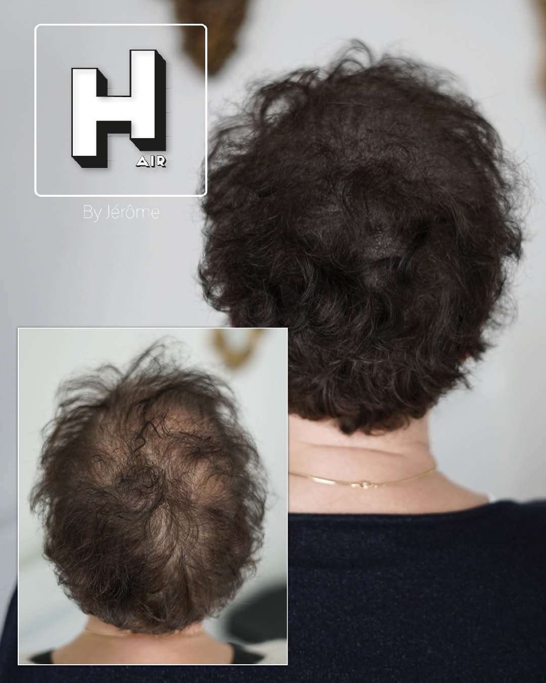 Micropigmentation Capillaire pour perte de cheveux chez la femme