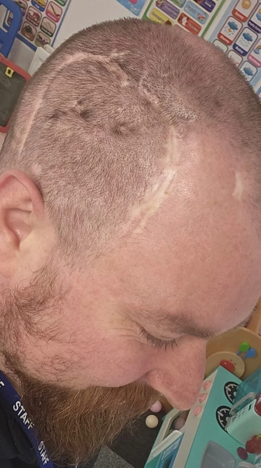 Luke%27s+scar.jpg