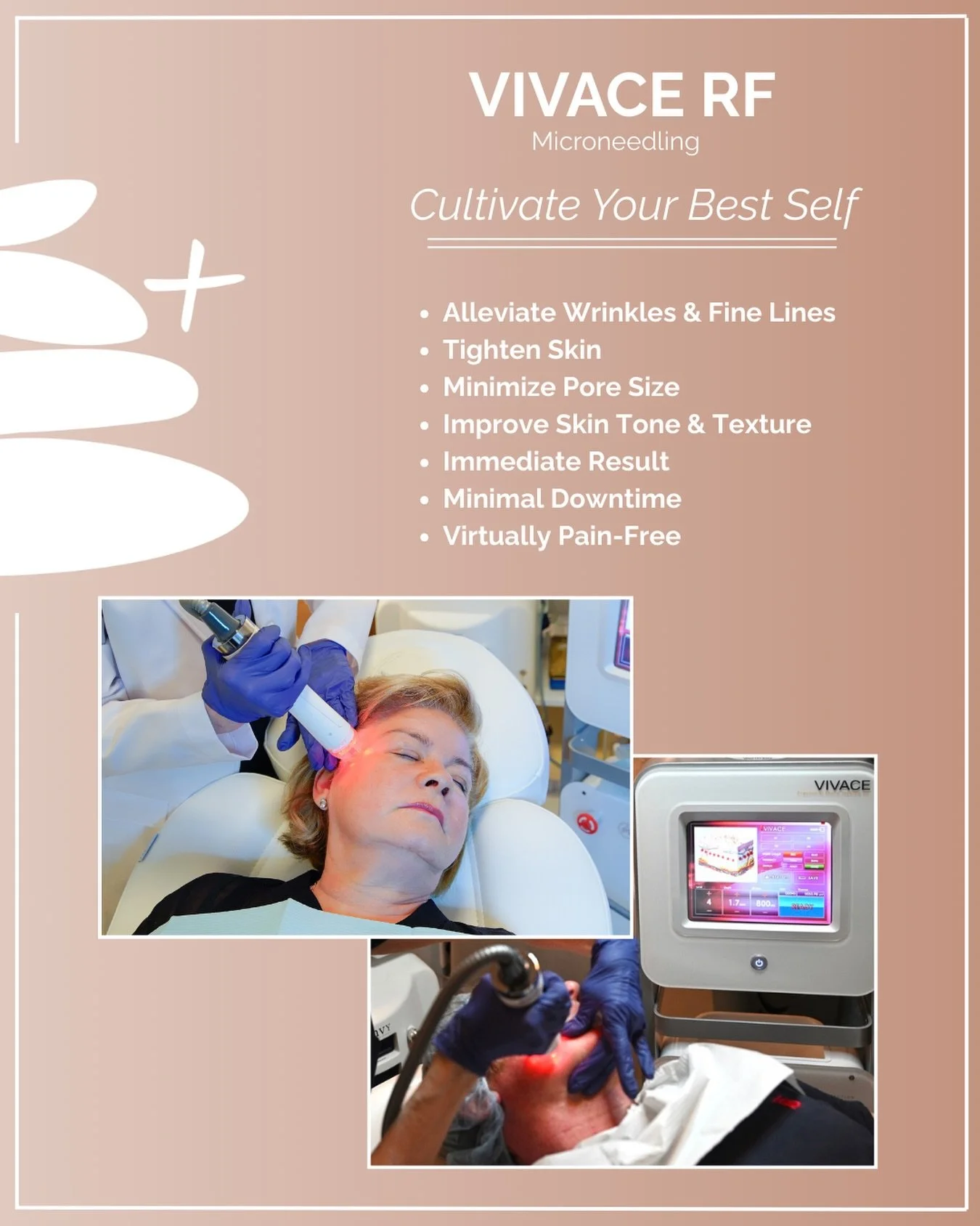 Final opportunity to indulge in Vivace RF at 50% off, an innovative treatment that seamlessly integrates radio frequency with microneedling. This advanced modality unites the skin-tightening benefits of radio frequency with the collagen boosting and 