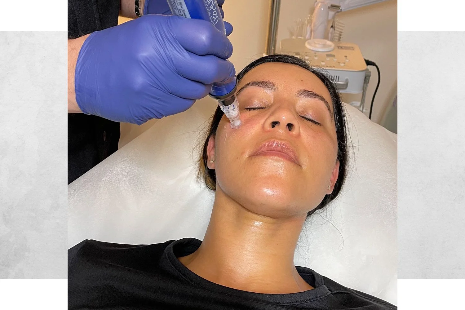 A woman with closed eyes is receiving a cosmetic facial treatment with a small device held by a person wearing blue gloves, in a clinical setting.