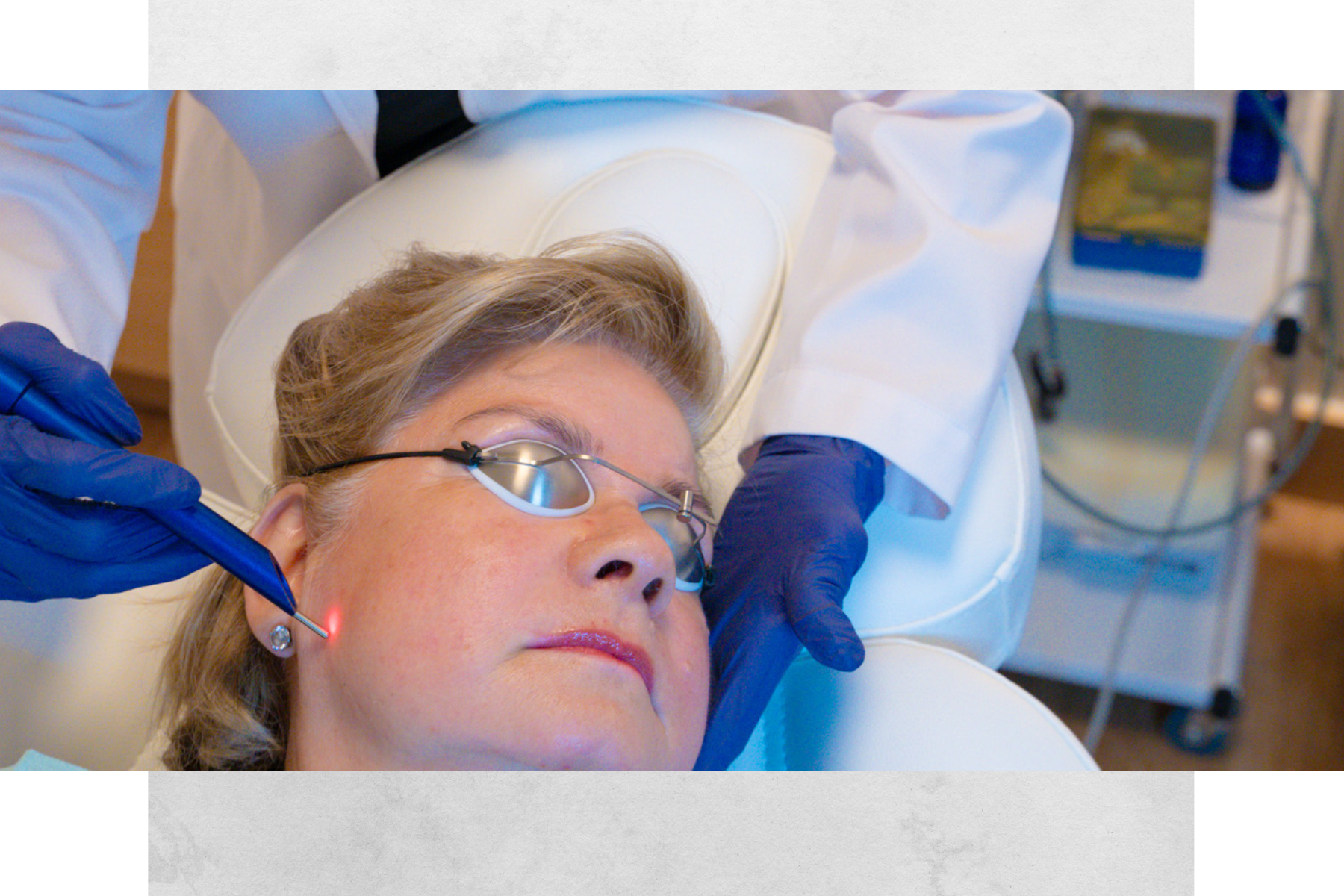A woman lying down on a medical device, undergoing a laser skin treatment. She is wearing glasses and the procedure is being performed by a medical professional with gloved hands.