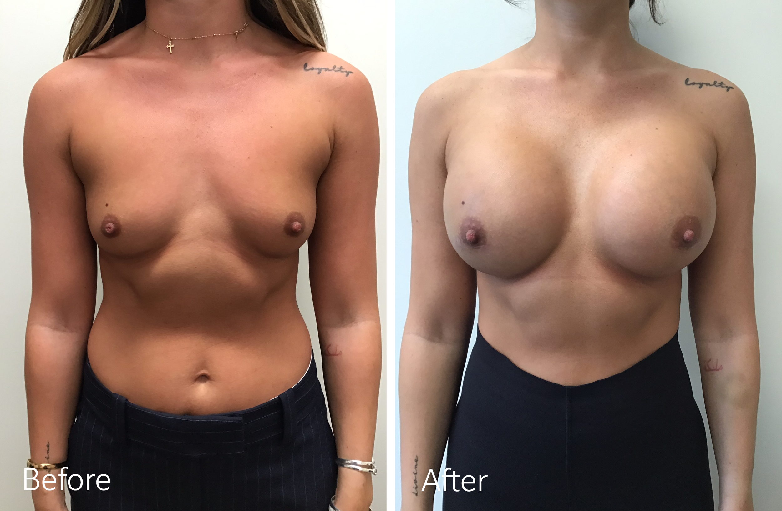 Dr Steven Porto Indianapolis Indiana Breast Augmentation Surgeon