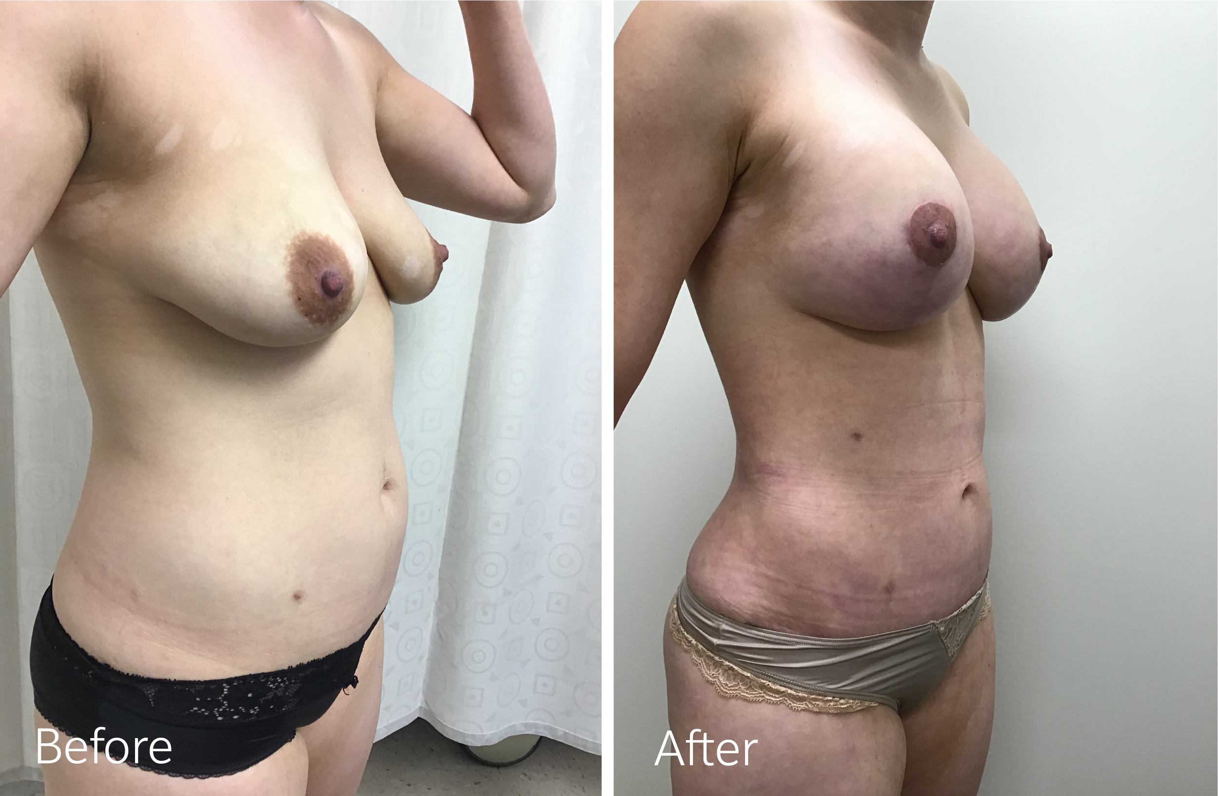 Mommy Makeover Tummy Tuck, Liposuction, Breast Lift and Implants by Dr. Steven Porto, Board Certified Plastic Surgeon in Indianapolis, Indiana