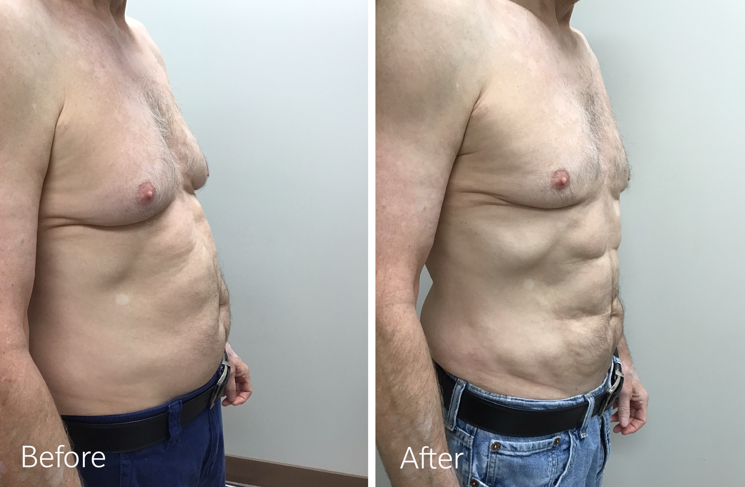Tummy tuck, breast lift and implant surgery by Dr. Steven Porto, Board Certified Plastic Surgeon in Indianapolis, Indiana