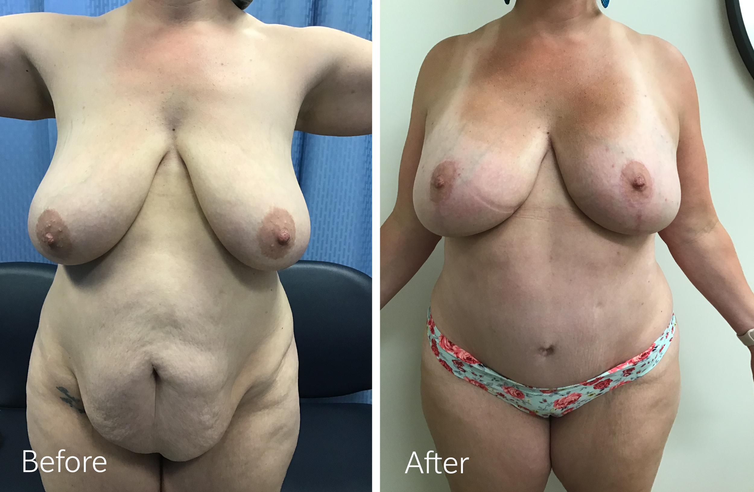 Mommy Makeover Tummy Tuck, Liposuction, Breast Lift and Implants by Dr. Steven Porto, Board Certified Plastic Surgeon in Indianapolis, Indiana