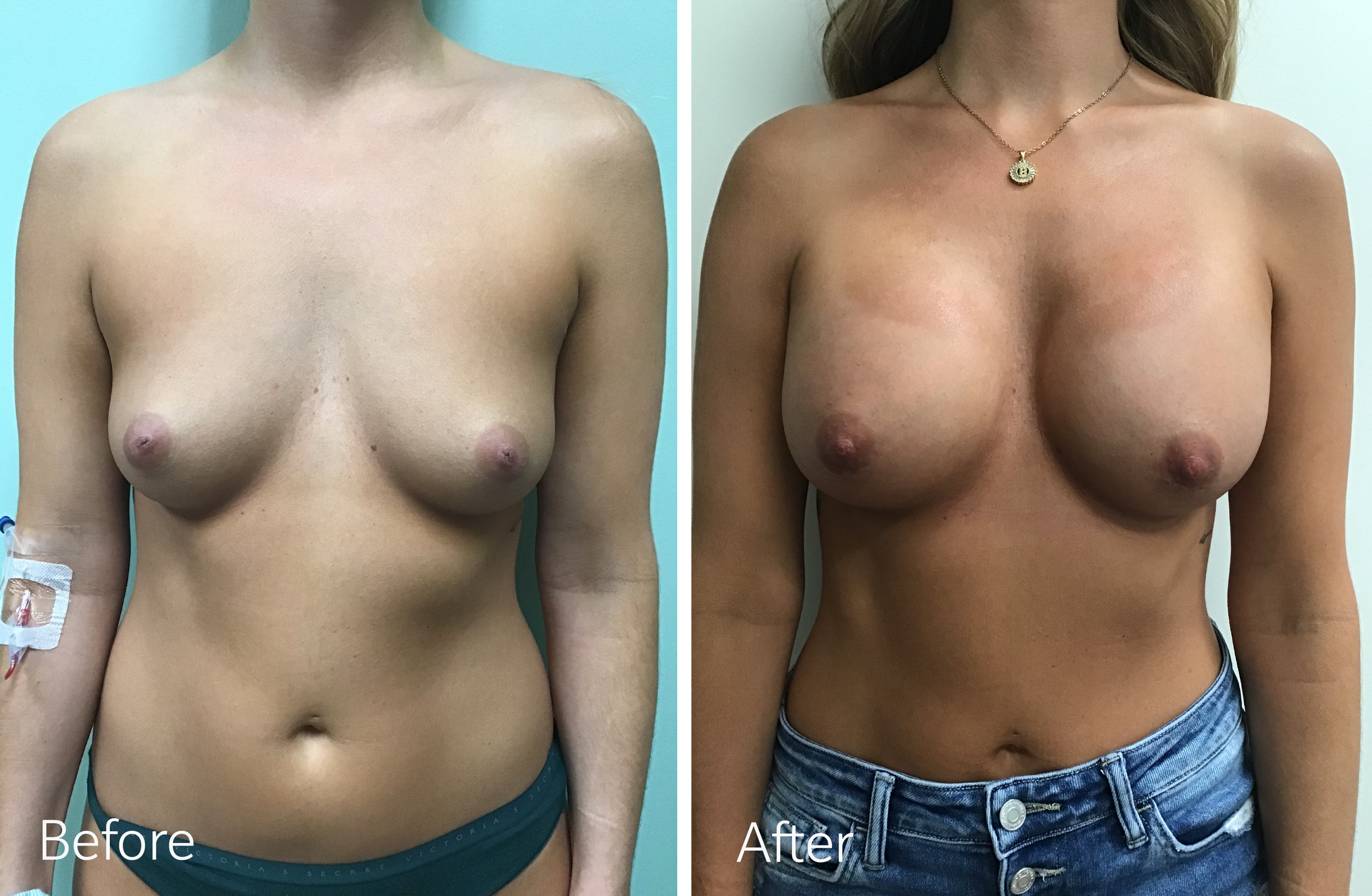 Breast Augmentation Surgery with 400cc Implants by Dr. Steven Porto