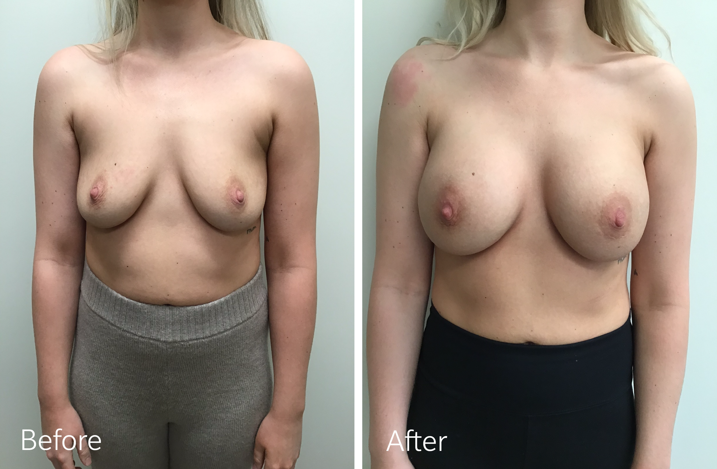 Breast Augmentation Surgery with 365cc Implants by Dr. Steven Porto