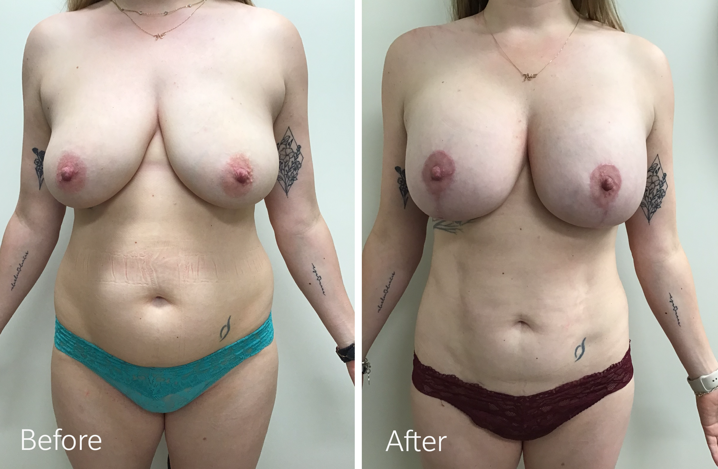 Tummy tuck, breast lift and implant surgery by Dr. Steven Porto, Board Certified Plastic Surgeon in Indianapolis, Indiana