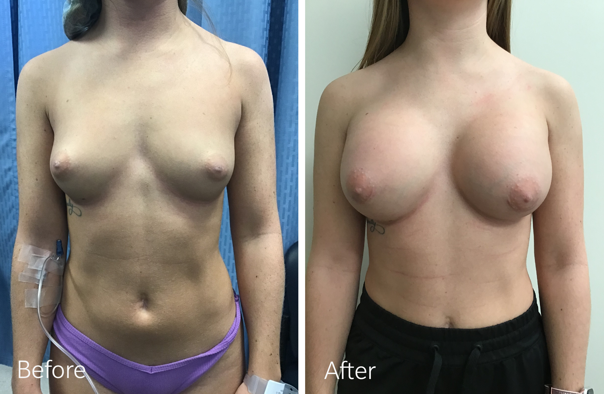 Breast Augmentation Surgery with 295cc Implants by Dr. Steven Porto