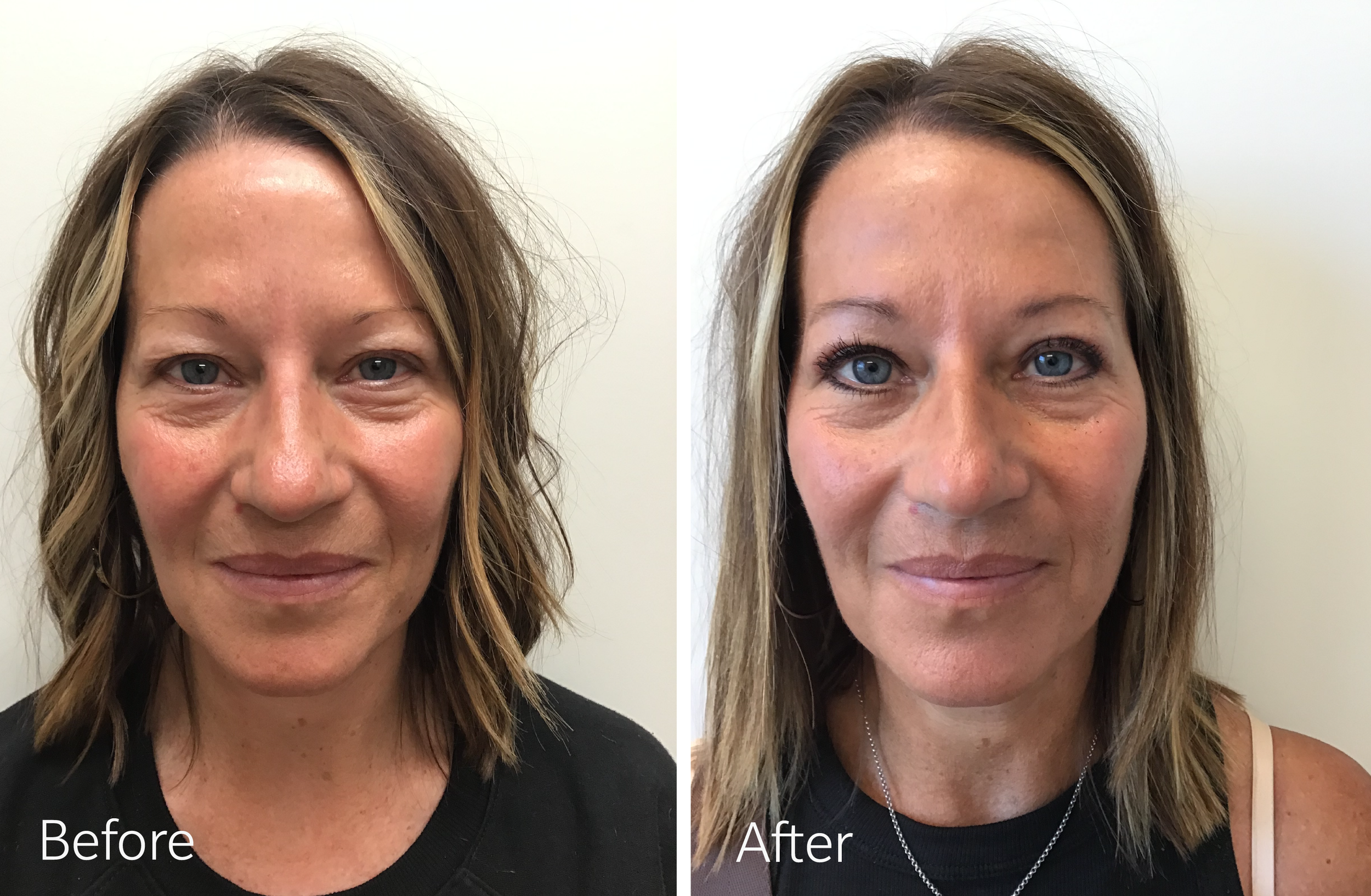 Eyelid surgery by Dr. Steven Porto, Board Certified Plastic Surgeon in Indianapolis, Indiana