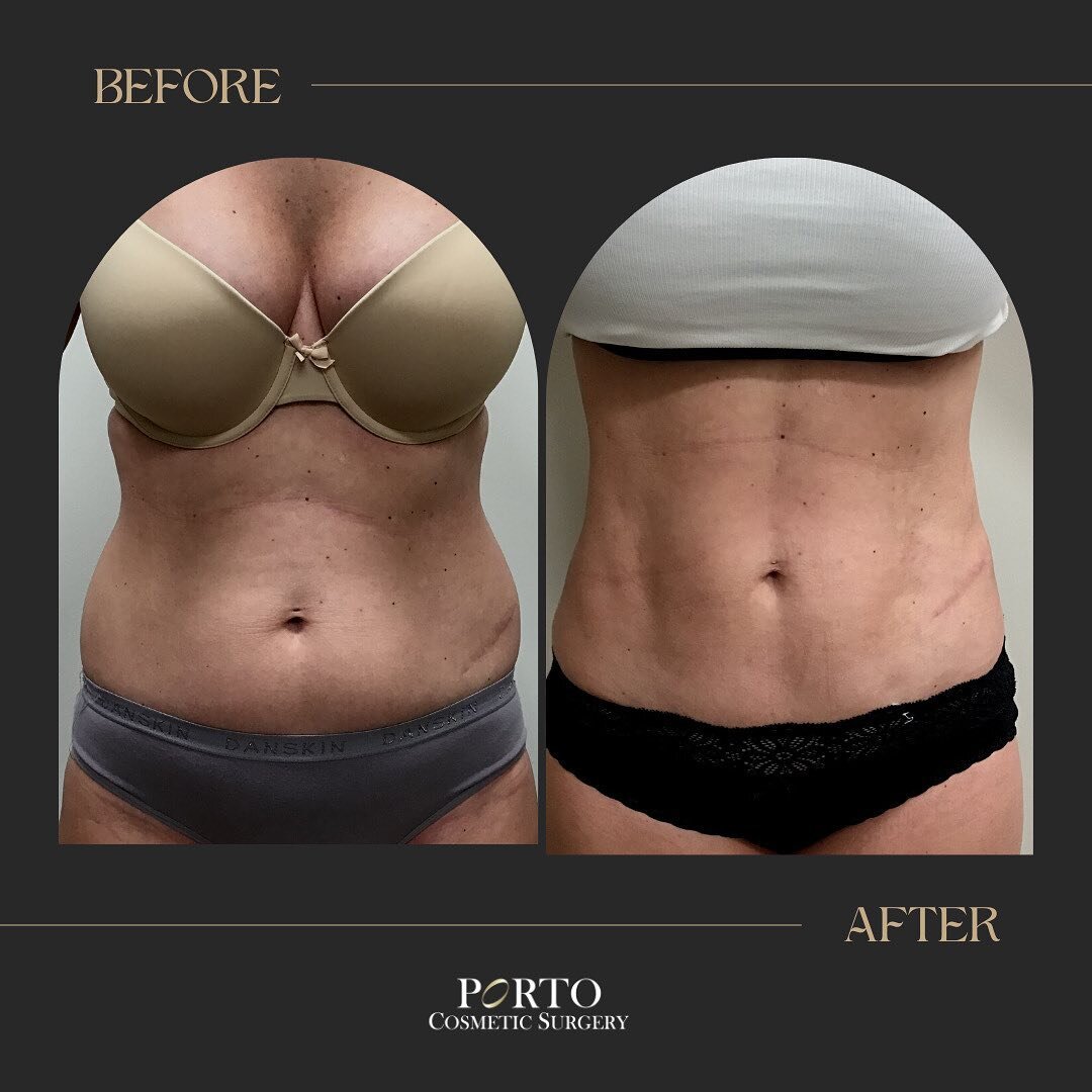 𝐻𝑒𝓁𝓁𝑜 𝒱𝒜𝒮𝐸𝑅 🖤
⠀⠀⠀⠀⠀⠀⠀⠀⠀
--360 𝑽𝑨𝑺𝑬𝑹 Liposuction
--8 weeks 𝘱𝘰𝘴𝘵-𝘰𝘱 🗓
⠀⠀⠀⠀⠀⠀⠀⠀⠀
So...what is 𝙑𝘼𝙎𝙀𝙍?!
⠀⠀⠀⠀⠀⠀⠀⠀⠀
&quot;VASER stands for 'Vibration Amplification of Sound Energy at Resonance'. It is a liposuction technique that