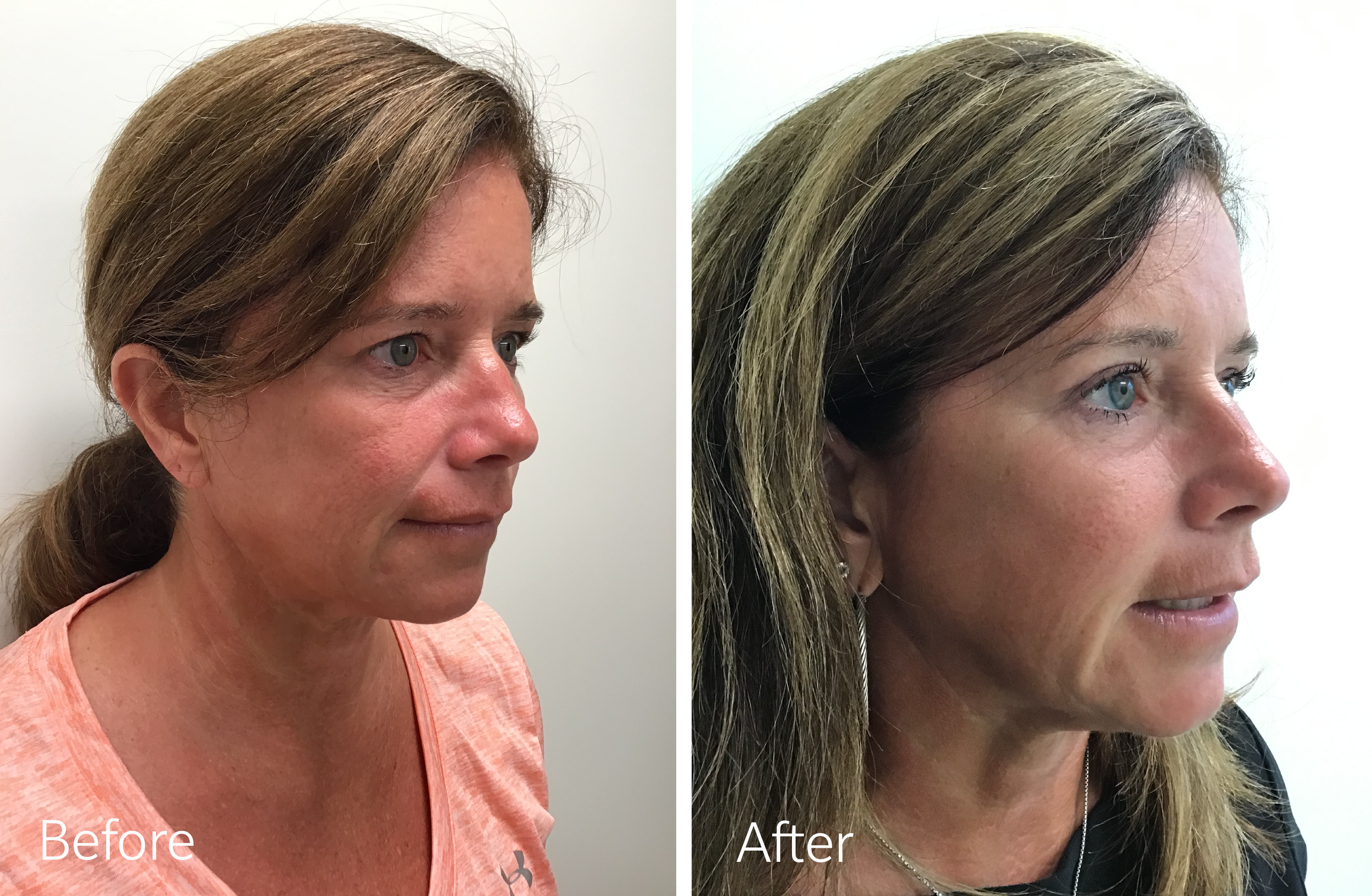 Eyelid surgery by Dr. Steven Porto, Board Certified Plastic Surgeon in Indianapolis, Indiana