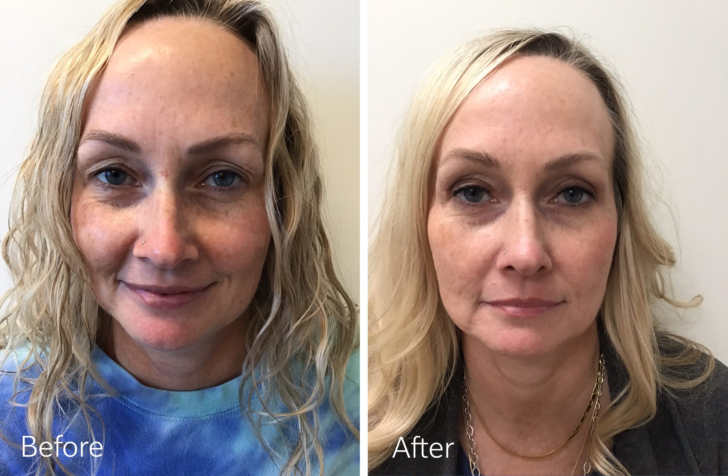 Eyelid lift surgery by Dr. Steven Porto, Board Certified Plastic Surgeon in Indianapolis, Indiana