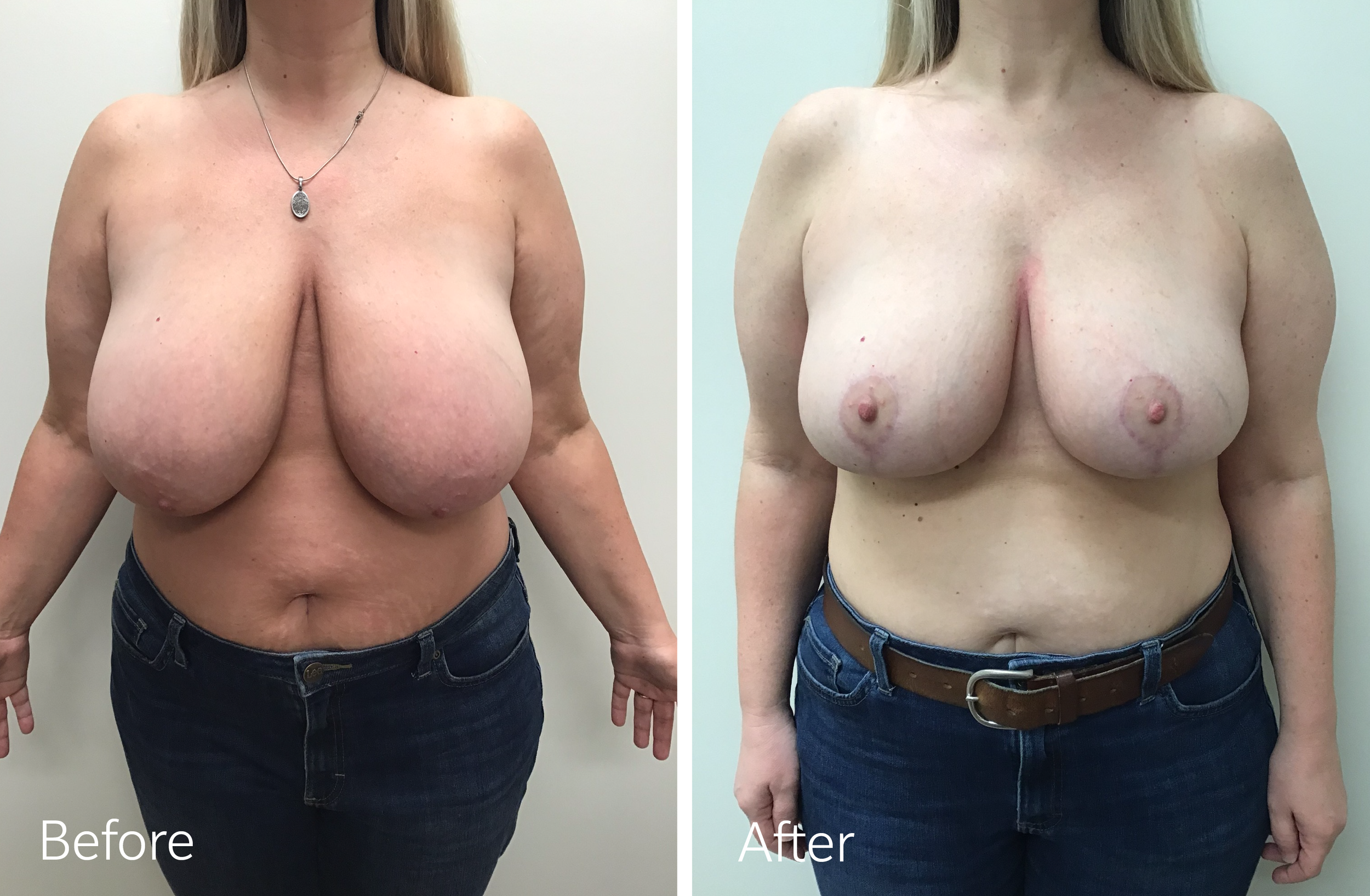 Breast Reduction Surgery by Dr Steven Porto in Fishers, Indiana