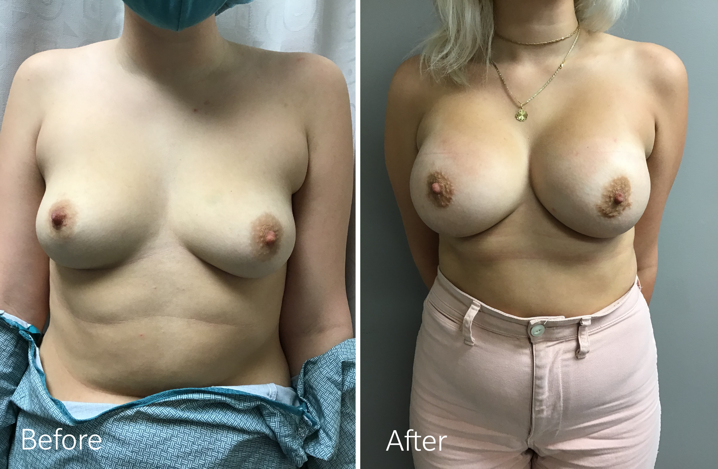 Breast Augmentation Surgery with 465cc Implants by Dr. Steven Porto