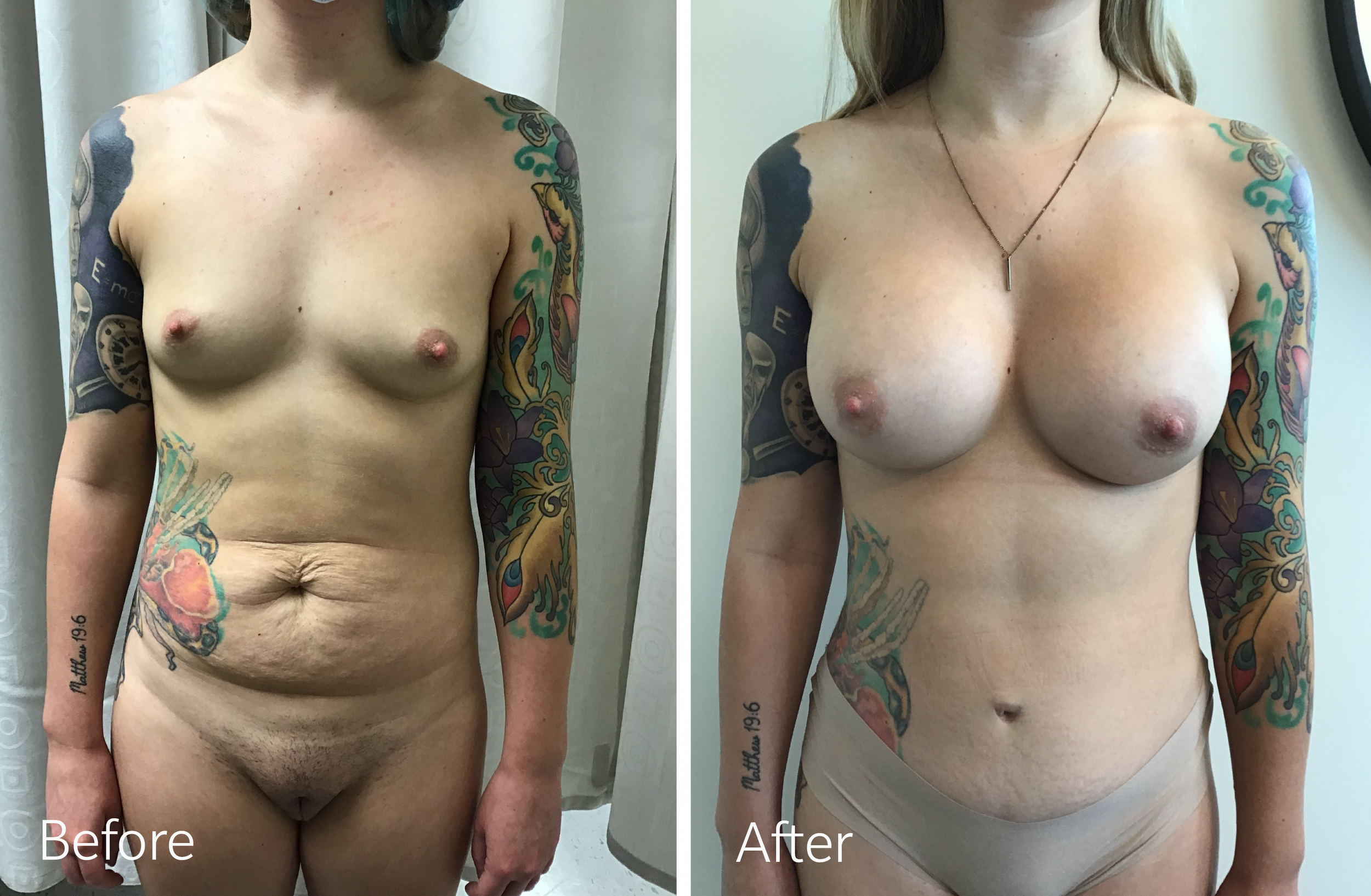 Mommy Makeover Tummy Tuck, Liposuction, Breast Lift and Implants by Dr. Steven Porto, Board Certified Plastic Surgeon in Indianapolis, Indiana