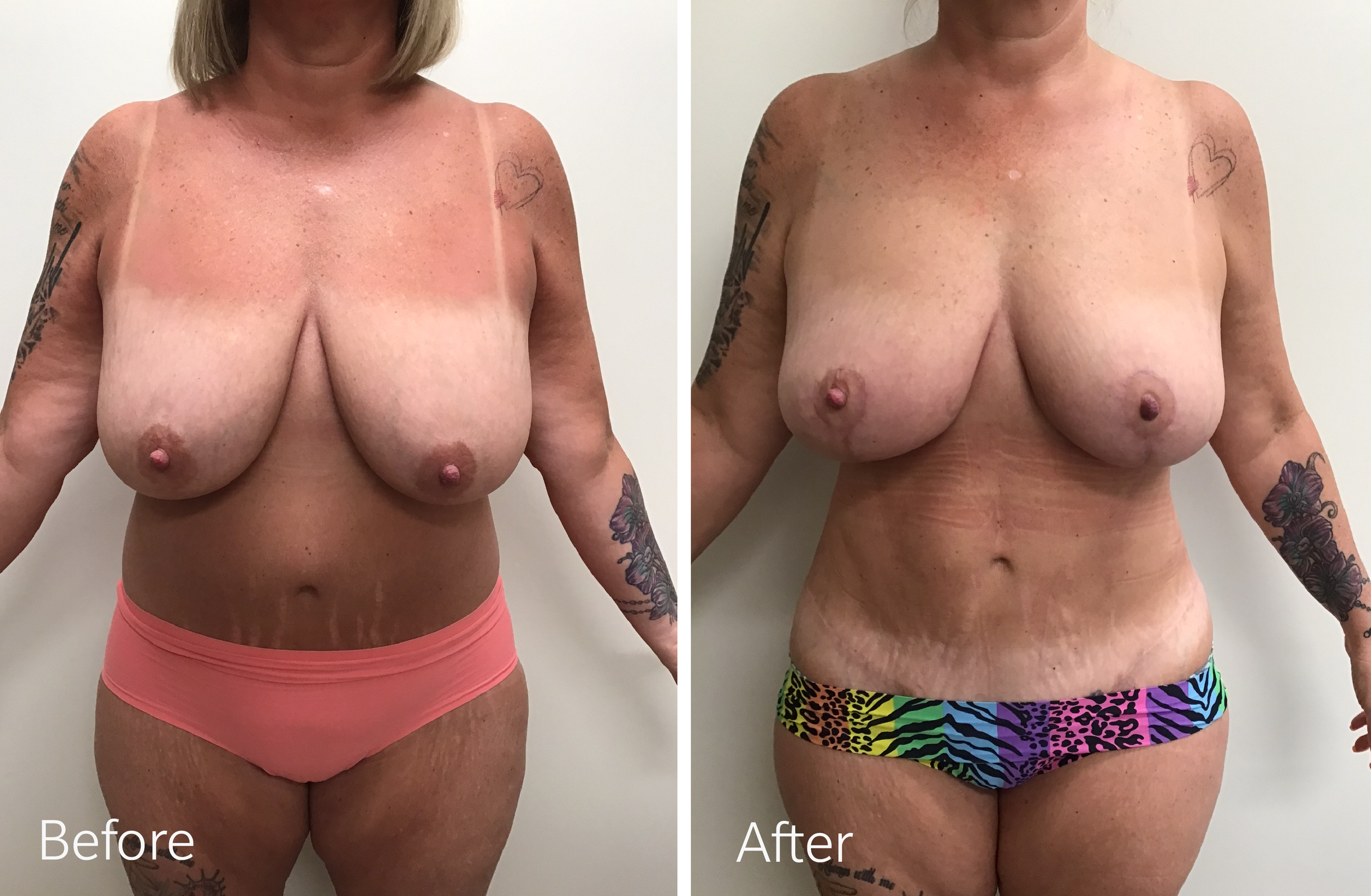 Tummy tuck, breast lift and implant surgery by Dr. Steven Porto, Board Certified Plastic Surgeon in Indianapolis, Indiana